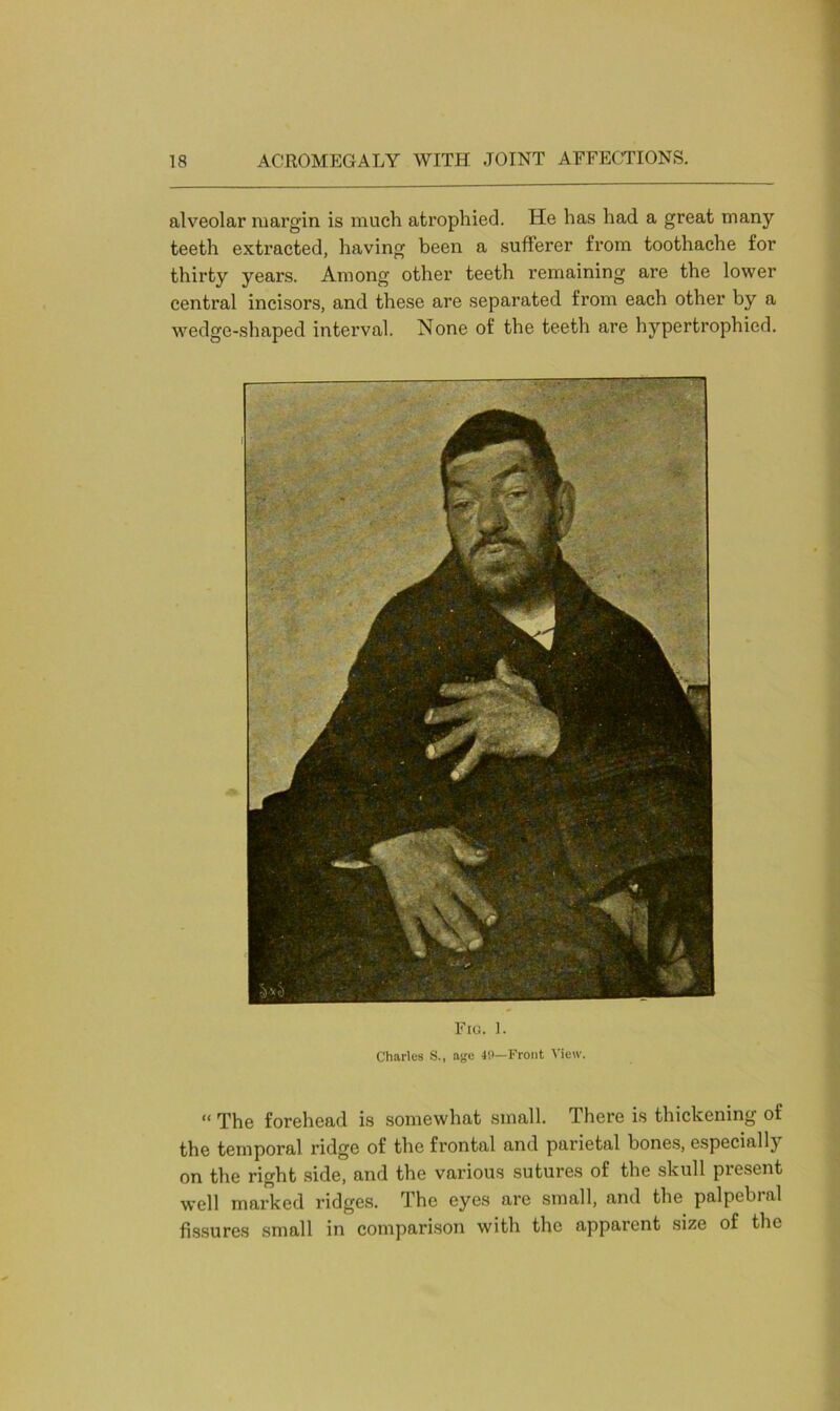 alveolar margin is much atrophied. He has had a great many teeth extracted, having been a sufferer from toothache for thirty years. Among other teeth remaining are the lower central incisors, and these are separated from each other by a wedge-shaped interval. None of the teeth are hypertrophied. Fig. 1. Charles S., age 40—Front View. “ The forehead is somewhat small. There is thickening of the temporal ridge of the frontal and parietal bones, especially on the right side, and the various sutures of the skull present well marked ridges. The eyes are small, and the palpebial fissures small in comparison with the apparent size of the