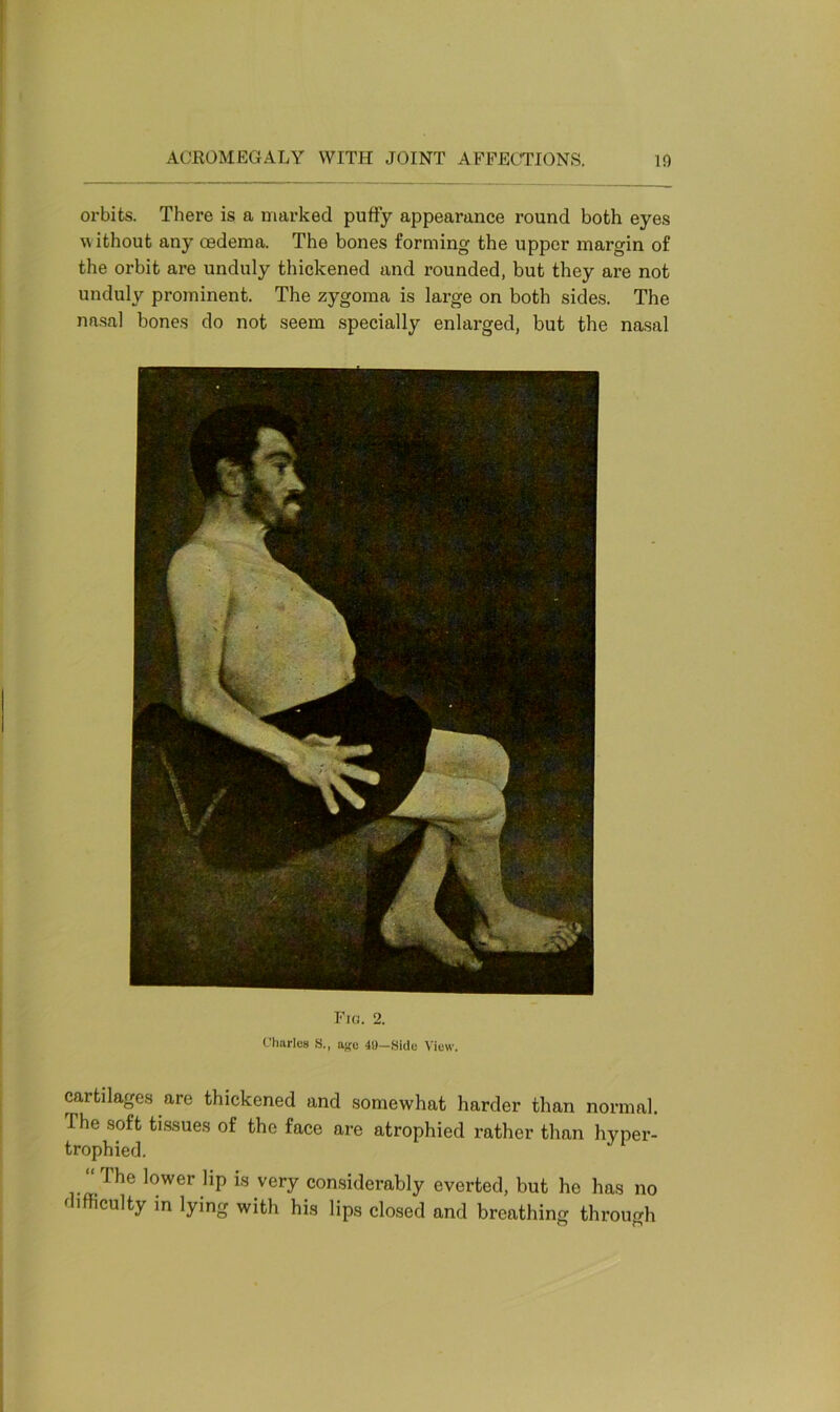 orbits. There is a marked puffy appearance round both eyes without any oedema. The bones forming the upper margin of the orbit are unduly thickened and rounded, but they are not unduly prominent. The zygoma is large on both sides. The nasal bones do not seem specially enlarged, but the nasal Fig. 2. Charles S., ago 49-Side View. cartilages are thickened and somewhat harder than normal. The soft tissues of the face are atrophied rather than hyper- trophied. ' i 1 The lower lip is very considerably everted, but he has no difficulty in lying with his lips closed and breathing through O o