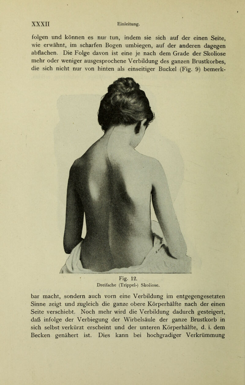 Fig. 12. Dreifache (Trippei-) Skoliose. bar macht, sondern auch vorn eine Verbildung im entgegengesetzten Sinne zeigt und zugleich die ganze obere Körperhälfte nach der einen Seite verschiebt. Noch mehr wird die Verbildung dadurch gesteigert, daß infolge der Verbiegung der Wirbelsäule der ganze Brustkorb in sich selbst verkürzt erscheint und der unteren Körperhälfte, d. i. dem Becken genähert ist. Dies kann bei hochgradiger Verkrümmung folgen und können es nur tun, indem sie sich auf der einen Seite, wie erwähnt, im scharfen Bogen umbiegen, auf der anderen dagegen abflachen. Die Folge davon ist eine je nach dem Grade der Skoliose mehr oder weniger ausgesprochene Verbildung des ganzen Brustkorbes, die sich nicht nur von hinten als einseitiger Buckel (Fig. 9) bemerk-