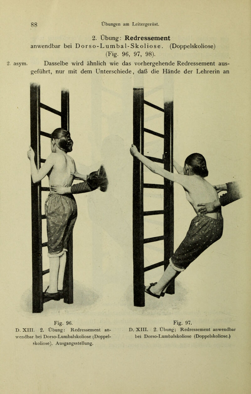 Fig. 96. Fig. 97. D. XIII. 2. Übung: Redressement an- D. XIII. 2. Übung; Redressement anwendbar wendbar bei Dorso-Lumbalskoliose (Doppel- bei Dorso-Lumbalskoliose (Doppelskoliose.) skoliose). Ausgangsstellung. gg Übungen am Leitergerüst. 2. Übung: Redressement anwendbar bei Dorso-Lumbal-Skoliose. (Doppelskoliose) (Fig. 96, 97, 98). asym. Dasselbe wird ähnlich wie das vorhergehende Redressement aus- geführt, nur mit dem Unterschiede, daß die Hände der Lehrerin an