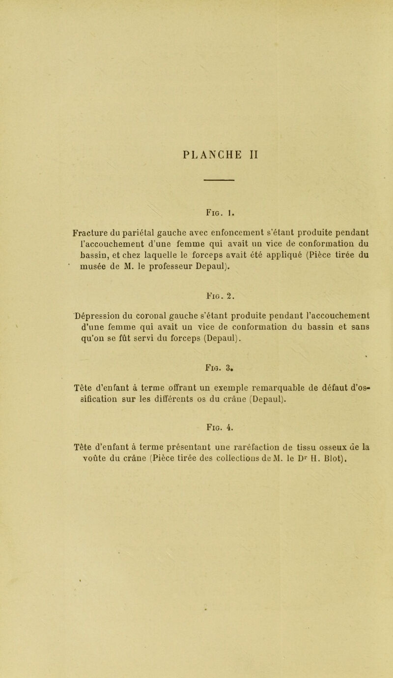 Fig, 1. Fracture du pariétal gauche avec enfoncement s’étant produite pendant l’accouchement d’une femme qui avait un vice de conformation du bassin, et chez laquelle le forceps avait été appliqué (Pièce tirée du musée de M. le professeur Depaul]. Fig. 2. Dépression du coroual gauche s’étant produite pendant l’accouchement d’une femme qui avait un vice de conformation du bassin et sans qu’on se fût servi du forceps (Depaul). Fig. 3. Tête d’enfant à terme offrant un exemple remarquable de défaut d’os- sification sur les différents os du crâne (Depaul). Fig. 4. Tête d’enfant à terme présentant une raréfaction de tissu osseux de la voûte du crâne (Pièce tirée des collections de M. le D’’ H. Slot),