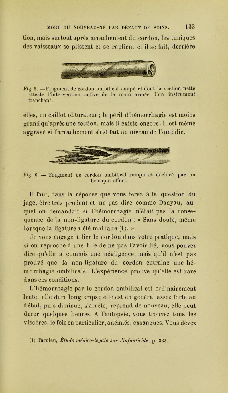 don, mais surtout après arrachement du cordon, les tuniques des vaisseaux se plissent et se replient et il se fait, derrière Fig. 5. —Fragment de cordon ombilical coupé et dont la section nette atteste l’intervention active de la main armée d’un instrument tranchant. elles, un caillot obturateur; le péril d’hémorrhagie est moins grand qu’aprèsune section, mais il existe encore. Il est même aggravé si l’arrachement s’est fait au niveau de l’ombilic. Fig. 6. — Fragment de cordon ombilical rompu et déchiré par un brusque effort. Il faut, dans la réponse que vous ferez à la question du juge, être très prudent et ne pas dire comme Danyau, au- quel on demandait si l’hémorrhagie n’était pas la consé- quence de la non-ligature du cordon : « Sans doute, même lorsque la ligature a été mal faite (1). » Je vous engage à lier le cordon dans votre pratique, mais si on reproche à une fille de ne pas l’avoir lié, vous pouvez dire qu’elle a commis une négligence, mais qu’il n’est pas prouvé que la non-ligature du cordon entraîne une hé- morrhagie ombilicale. L’expérience prouve qu’elle est rare dans ces conditions. L’hémorrhagie par le cordon ombilical est ordinairement lente, elle dure longtemps ; elle est en général assez forte au début, puis diminue, s’arrête, reprend de nouveau, elle peut durer quelques heures. A l’autopsie, vous trouvez tous les viscères, le foie en particulier, anémiés, exsangues. Vous devez (1) Tardieu, Étude médico-Léçfale sur Cinfantidde^ p. 333.