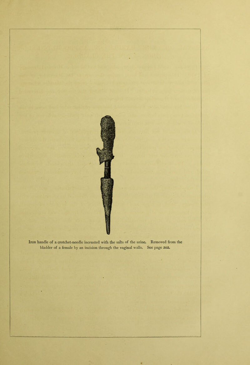 Iron handle of a crotchet-needle incrusted with the salts of the urine, bladder of a female by an incision through the vaginal walls. Removed from the See page 202.