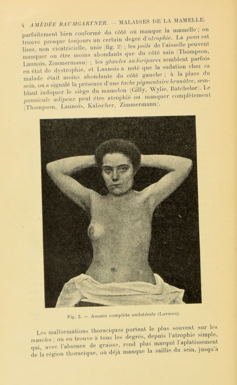 parl'.Mlemenl bien conlbrmé du côté où manque la mamelle • on rouve près,[lie Uiuiours un cerlain déféré iValroplue. La pum e s non c calncelle, unie (lig. '2) ; les poil, de la.ssel e peuveni ,,uÛmuer ou èlre moins ahondanls ,,ue ,lu côlé sam Ibompso , Lannois, Zimmermann) ; les glande, .adonpare. soLnblent pailo en élal (le dvstropliie, et Lannois a noté (pie la sudaUon chez s malade élaii moins abondante du colé gauche ; a la l''»ce  sein, on a signalé la présence d'une lâche pigmenlaire ,rnn„/ee, sen - blan’l indiquer le siège du mamelon (Gilly, Wyhe, Lalcbe oi). . pannicüle adipeux peut ,Hre alropl.ié ou manquer complètement (Thomp^^on, Lannois, Kalisclier, Zimmeniiann;. I es maltormalions thoraciques portent le plus souvent sur les muscle. : on en trouve à tous les degrés, depuis 1 e ®’ ' ; avec l'absence ,1e graisse, reml plus manpté 1 aplat.ssemen dë ia région thoracique, où déjà manque la sailhe du sein, jusqu a