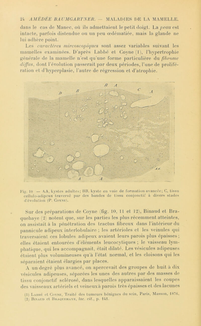 clans le cas de Manec, où ils admettaienl le petit doigt. La est intacle, parfois distendue ou iin j)eu œdématiée, mais la glande ne lui adhère point. Les caraclèrcs nurcosco])ûjiics sont assez variables suivant les mamelles examinées. D’après Labbé et Coyne (1), l’hypertrophie générale de la mamelle n’est cju’une forme particulière du fihi'ome diffus, dont l’évolution passerait par deux périodes, l’une de prolifé- ration et d’hypei'plasie, l’autre de régression et d’atrophie. 10 — AA, kystes adultes; liB, kyste eu voie de format iuii avancée ; G, tissu cellulo-adipcux traversé par des bandes de tissu conjonetif à divers stades d'évolutif)!! (P. Coym:). Sur des {^réparations de Coyne (fig. 10, 11 et 12), Binaud et Bra- (juehaye (2) notent f{ue, sur les parties les plus récemment atteintes, on assistait à la pénétration des tractus libreux dans l’intérieur du pannicule adipeux interlobulaire ; les artérioles et les veinules ({ui traversaient ces lobules adipeux avaient leurs parois plus épaisses; elles étaient entourées d’éléments leucocyti(|ues ; le vaisseau lym- phati({ue, cjui les accompagnait, était dilaté. Les vésicules adipeuses étaient plus volumineuses (]u’à l’état normal, et les cloisons c{ui les séparaient étaient élargies par places. A un degré plus avancé, on apercevait des groupes de huit à dix vésicules adipeuses, séparées les unes des autres par des masses de tissu conjonctif sclérosé, dans Icscfuellcs apparaissaient les coupes des vaisseaux artériels et, veineux à parois très éj^aisses et des lacunes (1) Lauuk et f]o!^E, Traite des tumeurs l)cnigncs du sein, Paris, Masson, 187G. (2J Binaud et J}haquehayk, Ioc. cil., p. 141.