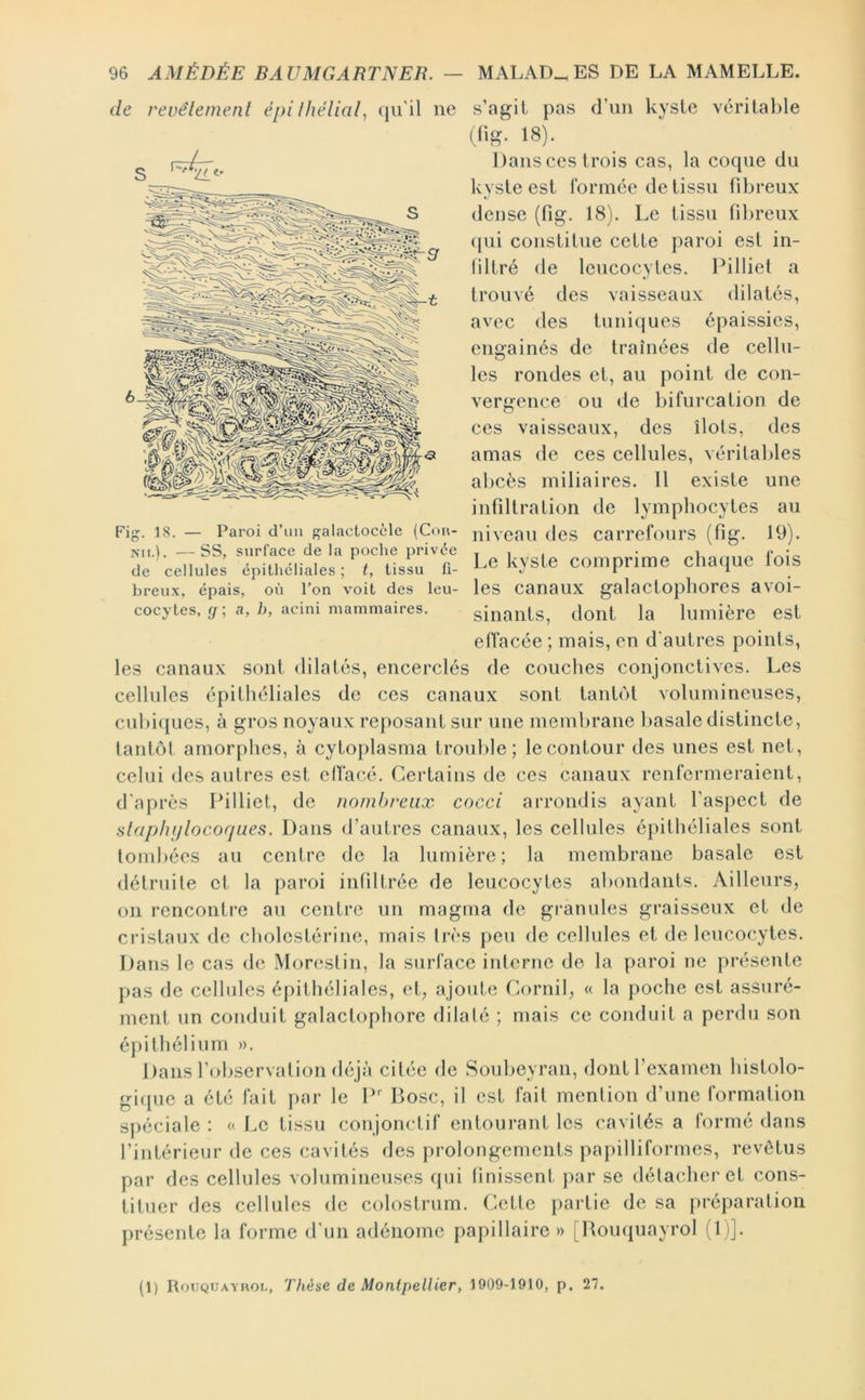 6^ de revêlement épi Ihêlial, (jii'il ne s’agil pas d’iin kyste véritable (^üg. 18). Dans ces trois cas, la coque du kyste est lornice de tissu fibreux dense (fig. 18). Le tissu fibreux ([ui constitue cette paroi est in- liltré de leucocytes. Pilliet a trouvé des vaisseaux dilatés, avec des tuniques épaissies, engainés de traînées de cellu- les rondes et, au point de con- vergence ou de bifurcation de ces vaisseaux, des îlots, des amas de ces cellules, véritables abcès miliaires. Il existe une infiltration de lymphocytes au Fig. 18. — Paroi d’un galactoccle (Cou- niyeau des carrefours (fig. 19). Nil,). —SS, surface de la poche privée t i i ■ i . iv;,- de cellules épilhcliales; 1, tissu fl- I,e kysle comprime chaque lois breux, épais, où l’on voit des leu- les canaux galactophores avoi- cocytes, I/; a, b, acim mammaires. sinauts, dont la lumière est effacée ; mais, en d'autres points, les canaux sont dilatés, encerclés de couches conjonctives. Les cellules épithéliales de ces canaux sont tantôt volumineuses, cubi(]ues, à gros noyaux reposant sur une memlirane basale distincte, tantôt amorphes, à cytoplasma trouille; lecontour des unes est net, celui des autres est etfacé. Certains de ces canaux renfermeraient, d'après Pilliet, de nombreux cocci arrondis ayant faspect de slaphiilocorjues. Dans d’autres canaux, les cellules épithéliales sont tombées au centre de la lumière; la membrane basale est détruite et la paroi infiltrée de leucocytes abondants. Ailleurs, on rencontre au centre un magma de gi-anules graisseux et de cristaux de cholestérine, mais très peu de cellules et de leucocytes. Dans le cas de Morestin, la surface interne de la paroi ne présente pas de cellules épithéliales, et, ajoute Cornil, « la poche est assuré- ment un conduit galactophore dilaté ; mais ce conduit a perdu son épithélium ». Dans l’observation déjà citée de Soubeyran, dont l’examen histolo- gique a été fait par le P Dose, il est fait mention d’une formation s[)éciale ; « Le tissu conjonctif entourant les cavités a formé dans l’intérieur de ces cavités des prolongements papilliformes, revêtus par des cellules volumineuses qui finissent par se détacher et cons- tituer des cellules de colostrum. Cette partie de sa préparation présente la forme d'un adénome papillaire » [Houquayrol (1 )]. (1) Rocqcayroi,, Thèse de Montpellier, 1909-1910, p. 27.