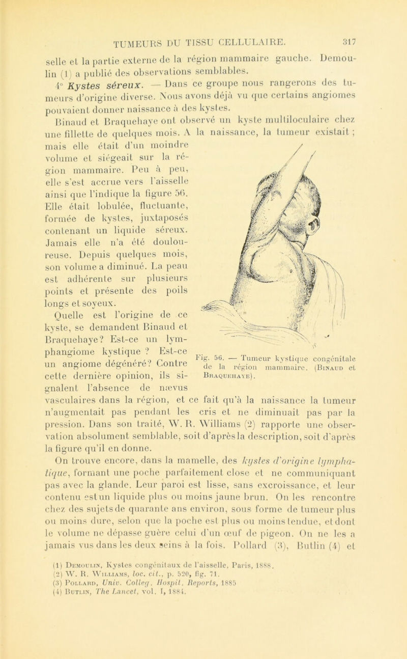 Demou- selle eL la partie externe de la région mammaire gauche, lin (1) a publié des observations setnblables. U Kystes séreux. — Uans ce groupe nous rangerons des tu- meurs d’origine diverse. \ous avons déjà vu (pic certains angiomes pouvaient donner naissance a des kysles. Rinaud et Braquebaye ont observé un kyste mulliloculaire chez une fillette de quehpies mois. A la naissance, la lumeur existait ; mais elle était d’un moindre volume et siégeait sur la ré- gion mammaire. Peu à peu, elle s’est accrue vers l’aisselle ainsi que l’indique la figure 5b. Elle était lobulée, fluctuante, formée de kystes, juxtaposés contenant un liquide séreux. Jamais elle n’a été doulou- reuse. Dei)uis quelques mois, son volume a diminué. La peau est adhérente sur plusieurs points et présente des poils longs et soyeux. Ouelle est l’origine de ce kyste, se demandent Binaud et Braquehaye? Est-ce un lym- phangiome kystique ? Est-ce un angiome dégénéré? Contre celte dernière opinion, ils si- gnalent l’absence de nævus vasculaires dans la région, et ce fait qu’à la naissance la tumeur n’augmentait pas pendant les cris et ne diminuait pas par la pression. Dans son traité, W. R. ^^’illiams ('J) rapporte une obser- vation absolument semblable, soit d’après la description, soit d'après la figure (ju’il en donne. On trouve encore, dans la mamelle, des ki/sles (Vorigine lijmpha- iû/Lie., formant une poche parfaitement close et ne communiquant pas avec la glande. Leur paroi est lisse, sans excroissance, et leur contenu estun liquide plus ou moins jaune brun. On les rencontre chez des sujets de quarante ans environ, sous forme de tumeur plus ou moins dure, selon cpie la poche est plus ou moins tendue, et dont le volume ne dépasse guère celui d’un œuf de jugeon. On ne les a jamais vus dans les deux seins à la fois. Dollard (3), Bullin (i) et Fig. 56. — Tumeur kysticjue congénitale de la région mammaire. (Binaud et Bm^QUIiHAVE). (1) Demoui.in, Kysles congénilau.x de l'aisselle, Paris, 18S8. {'2) H. Wii.uAMS, loc. cil., p. 520, fig. 71. (3) PoLi.AHD, Univ. Collpff. llospU. lîpporls, 1885 (1) Buti-in, The Lancel, vol. 1, 188i.