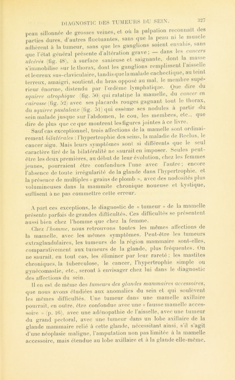 peau sillonnée de grosses veines, el on la palpation reconnaît des parlies dures, d’autres llnctuanles, sans (pic la peau ni le muscle adhèrent à la tumeur, sans que les ganglions soient envahis, sans <ine l’état général présente d’altération grave; — dans les cancers^ ulcérés (fig. i8), à snrtace saniense et saignante, dont la masse s’immobilise sur le thorax, dont les ganglions remplissent aisse e ctlecreux sus-claviculaire, tandisipielamalade cachectiipie, au tein terreux, amaigri, soutient, du bras opposé au mal, le mcmbie supé rieur énorme, distendu par l’œdème lymphatique. Oue dire du s(jiiirre citroj)lu(jiie (lig. uOi (jui ratatine la mamelle, du cctucei en i-iiirasse (fig. 52) avec ses placards rouges gagnant tout le thorax, du squirre piislaleiix (lig. 51) qui essème ses nodules à partir du sein malade jusque sur l’abdomen, le cou, les membres, etc., que dire de jilus (jue ce cpie montrent tes figures jointes a ce ümc. Sauf cas exceptionnel, trois allections de la mamelle sont ordinai- rement bilatérales : l’hypertrophie des seins, la maladie de Reclus, le cancer aigu. Mais leurs sympteunes sont si difïérents (jue le seul caractère tiré de la bilatéralité ne saurait en imposer. Seules peut- être les deux premières, au début de leur évolution, chez les femmes jeunes, pourraient (*tre conlondues lune avec lautic, encoie l’absence de toule irrégularilé de la glande dans l’hypertrophie, et la présence de multiples « grains de plomb », avec des nodosités plus volumineuses dans la mammite chroni({ue noueuse et kystique, ■suflisent à ne pas commettre cette erreur. A part ces exceptions, le diagnostic de « tumeur » de la mamelle présenle parfois de grandes ditlicullés. Ces difficulles se présentent aussi bien chez l’homme que chez la femme. Chez I hoiiiiiie^ nous retrouvons toutes les mêmes allections de la mamelle, avec les mômes symptômes. Reut-êlre les tumeuis extraglandulaires, les tumeurs de la région mammaire sont-elles, comparativement aux tumeurs de la glande, plus frequentes. On ne saurait, en lout cas, les (*liminer jiar leur rarete , les mastites chroniques, la tuberculose, le cancer, 1 hypertrophie simple ou g'ynécomasiie, etc., seront a envisager chez lui dans le diagnostic des alVeclions du sein. 11 en est de môme des liimeiirs des glandes mammaires accessoires, cpie nous avons étudiées aux anomalies du sein et qui souhAent les mêmes difhcultés. Une tumeur dans une mamelle axillaire pourrait, en outre, être confondue avec une « fausse mamelle acces- soire » (p. Ib), avec une adénopathie de l’aisselle, avec une tumeur du grand pectoral, avec une tumeur dans un lobe axillaire de la glande mammaire relié à cette glamie, nécessitant ainsi, s il s agit d’une néoplasie maligne, l’amputation non j)as limitée a la mamelle accessoire, mais étendue au lobe axillaire et à la glande elle-même.