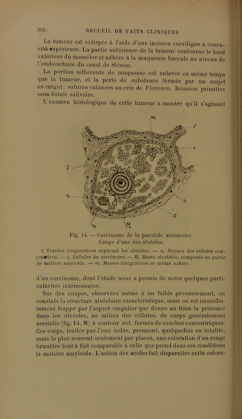 La tumeur est extirpée à l’aide d’une incision curviligne à conca- vité supérieure. La partie antérieure de la tumeur contourne le bord antérieur du masséter et adhère à la muqueuse buccale au niveau de l'embouchure du canal de Sténon. La portion adhérente de muqueuse est enlevée en même temps que la tumeur, et la perte de substance fermée par un surjet au catgut; sutures cutanées au crin de Florence. Réunion primitive sans fistule salivaire. L examen histologique de cette tumeur a montré qu'il s’agissait Fig. 14. — Carcinome de la parotide accessoire. Coupe d’une des alvéoles. t, Travées conjonctives séparant les alvéoles. — ?i, Noyaux des cellules con- jonctives. — c, Cellules du carcinome. — M, Masse stratifiée, composée en partie de matière amyloïde. — m, Masses irrégulières de même nature. d’un carcinome, dont l’étude nous a permis de noter quelques parti- cularités intéressantes. Sur des coupes, observées même à un faible grossissement, on constate la structure alvéolaire caractéristique, mais on est immédia- tement frappé par l’aspect singulier que donne au tissu la présence dans les alvéoles, au milieu des cellules, de corps généralement arrondis (fig. 14, M) à contour net, formés de couches concentriques. Ces corps, traités par l’eau iodée, prennent, quelquefois en totalité, mais le plus souvent seulement par places, une coloration d’un rouge brunâtre tout à fait comparable à celle que prend dans ces conditions la matière amyloïde. L’action des acides fait disparaître cette colora-