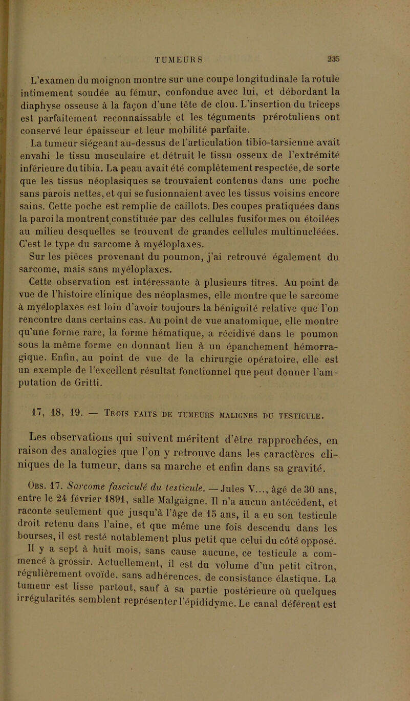 L’examen du moignon montre sur une coupe longitudinale la rotule intimement soudée au fémur, confondue avec lui, et débordant la diaphyse osseuse à la façon d’une tête de clou. L’insertion du triceps est parfaitement reconnaissable et les téguments prérotuliens ont conservé leur épaisseur et leur mobilité parfaite. La tumeur siégeant au-dessus de l’articulation tibio-tarsienne avait envahi le tissu musculaire et détruit le tissu osseux de l'extrémité inférieure du tibia. La peau avait été complètement respectée, de sorte que les tissus néoplasiques se trouvaient contenus dans une poche sans parois nettes, et qui se fusionnaient avec les tissus voisins encore sains. Cette poche est remplie de caillots. Des coupes pratiquées dans la paroi la montrent constituée par des cellules fusiformes ou étoilées au milieu desquelles se trouvent de grandes cellules multinucléées. C’est le type du sarcome à myéloplaxes. Sur les pièces provenant du poumon, j’ai retrouvé également du sarcome, mais sans myéloplaxes. Cette observation est intéressante à plusieurs titres. Au point de vue de l’histoire clinique des néoplasmes, elle montre que le sarcome à myéloplaxes est loin d’avoir toujours la bénignité relative que l’on rencontre dans certains cas. Au point de vue anatomique, elle montre qu’une forme rare, la forme hématique, a récidivé dans le poumon sous la même forme en donnant lieu à un épanchement hémorra- gique. Enfin, au point de vue de la chirurgie opératoire, elle est un exemple de l’excellent résultat fonctionnel que peut donner l’am- putation de Gritti. 17, 18, 19. Trois faits de tumeurs malignes du testicule. Les observations qui suivent méritent d être rapprochées, en raison des analogies que 1 on y retrouve dans les caractères cli- niques de la tumeur, dans sa marche et enfin dans sa gravité. ÜBS. 17. Sarcome fascicule du testicule. — Jules V..., âgé de 30 ans, entre le 24 février 1891, salle Malgaigne. Il n’a aucun antécédent, et raconte seulement que jusqu’à l’âge de 15 ans, il a eu son testicule droit retenu dans l’aine, et que même une fois descendu dans les bourses, il est resté notablement plus petit que celui du côté opposé. II y a sept a huit mois, sans cause aucune, ce testicule a com- mencé à grossir. Actuellement, il est du volume d’un petit citron, reguherement ovoïde, sans adhérences, de consistance élastique. La tumeur est lisse partout, sauf à sa partie postérieure où quelques irrégularités semblent représenter l’épididyme. Le canal déférent est