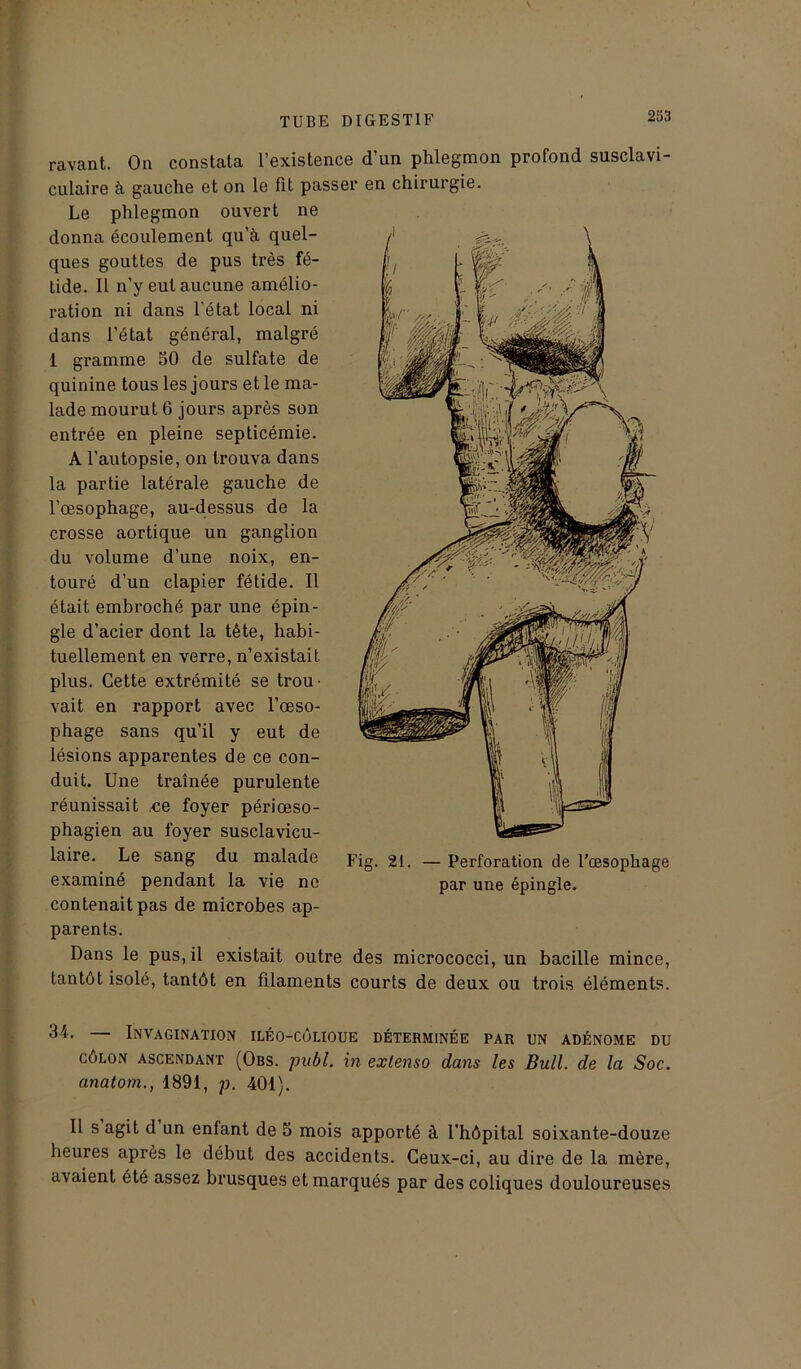 ravant. On constata l’existence d’un phlegmon profond susclavi- culaire à gauche et on le fit passer en chirurgie. Le phlegmon ouvert ne donna écoulement qu’à quel- ques gouttes de pus très fé- tide. Il n’y eut aucune amélio- ration ni dans l’état local ni dans l’état général, malgré 1 gramme 50 de sulfate de quinine tous les jours et le ma- lade mourut 6 jours après son entrée en pleine septicémie. A l’autopsie, on trouva dans la partie latérale gauche de l’oesophage, au-dessus de la crosse aortique un ganglion du volume d’une noix, en- touré d’un clapier fétide. Il était embroché par une épin- gle d’acier dont la tête, habi- tuellement en verre, n’existait plus. Cette extrémité se trou- vait en rapport avec l’œso- phage sans qu’il y eut de lésions apparentes de ce con- duit. Une traînée purulente réunissait ,ce foyer périœso- phagien au foyer susclavicu- laire. Le sang du malade examiné pendant la vie ne contenait pas de microbes ap- parents. Dans le pus, il existait outre des micrococci, un bacille mince, tantôt isolé, tantôt en filaments courts de deux ou trois éléments. Fig. 21. — Perforation de l’œsophage par une épingle. Invagination iléo-côlioue déterminée par un adénome du côlon ascendant (Obs. publ. in extenso dans les Bull, de la Soc. anatom., 1891, p. 401). Il s agit d un enfant de 5 mois apporté à l’hôpital soixante-douze heures après le début des accidents. Ceux-ci, au dire de la mère, avaient été assez brusques et marqués par des coliques douloureuses