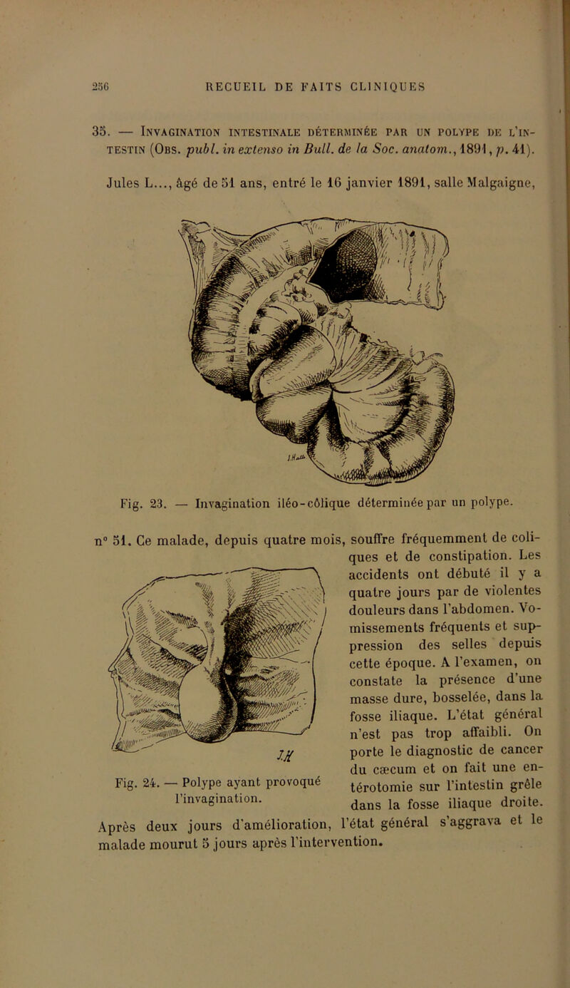 35. — Invagination intestinale déterminée par un polype de l’in- testin (Obs. publ. in extenso in Bull, de la Soc. anatom., 1891, p. 41). Jules L..., âgé de 51 ans, entré le 16 janvier 1891, salle Malgaigne, Fig. 23. — Invagination iiéo-côlique déterminée par un polype. n° 51. Ce malade, depuis quatre mois, souffre fréquemment de coli- ques et de constipation. Les accidents ont débuté il y a quatre jours par de violentes douleurs dans l’abdomen. Vo- missements fréquents et sup- pression des selles depuis cette époque. A l’examen, on constate la présence d’une masse dure, bosselée, dans la fosse iliaque. L’état général n’est pas trop affaibli. On porte le diagnostic de cancer du cæcum et on fait une en- térotomie sur l’intestin grêle dans la fosse iliaque droite. Après deux jours d'amélioration, l’état général s’aggrava et le malade mourut 5 jours après l’intervention. Fig. 24. — Polype ayant provoqué l’invagination.