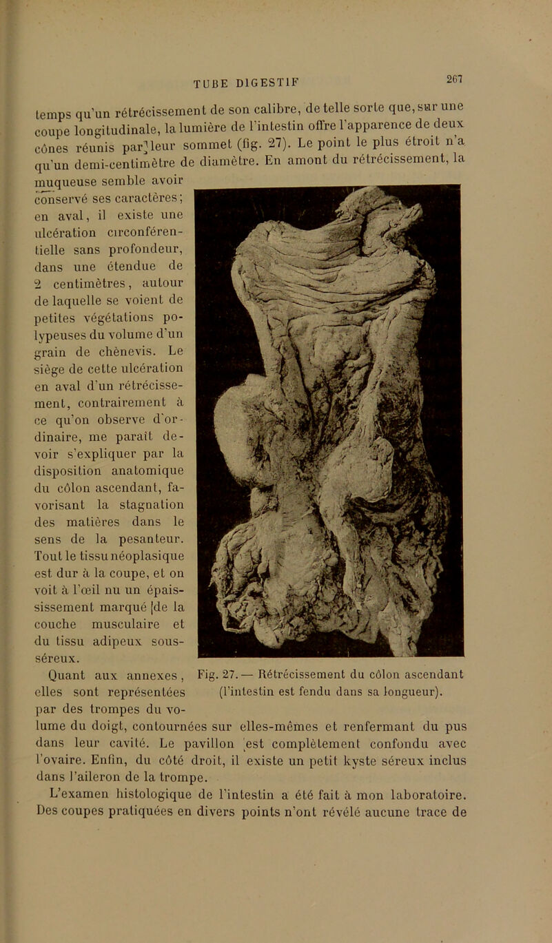 261 temps qu’un rétrécissement de son calibre, de telle sorte que, sur une coupe longitudinale, la lumière de l’intestin offre l'apparence de deux cônes réunis parleur sommet (fig. 27). Le point le plus étroit n’a quun demi-centimètre de diamètre. En amont du rétrécissement, la muqueuse semble avoir conservé ses caractères; en aval, il existe une ulcération circonféren- tielle sans profondeur, dans une étendue de 2 centimètres, autour de laquelle se voient de petites végétations po- lypeuses du volume d’un grain de chènevis. Le siège de cette ulcération en aval d’un rétrécisse- ment, contrairement à ce qu’on observe d'or- dinaire, me parait de- voir s’expliquer par la disposition anatomique du côlon ascendant, fa- vorisant la stagnation des matières dans le sens de la pesanteur. Tout le tissu néoplasique est dur à la coupe, et on voit à l’œil nu un épais- sissement marqué {de la couche musculaire et du tissu adipeux sous- séreux. Quant aux annexes, elles sont représentées par des trompes du vo- lume du doigt, contournées sur elles-mêmes et renfermant du pus dans leur cavité. Le pavillon est complètement confondu avec l’ovaire. Enfin, du côté droit, il existe un petit kyste séreux inclus dans l’aileron de la trompe. L’examen histologique de l’intestin a été fait à mon laboratoire. Des coupes pratiquées en divers points n’ont révélé aucune trace de Fig. 27.— Rétrécissement du côlon ascendant (l’intestin est fendu dans sa longueur).