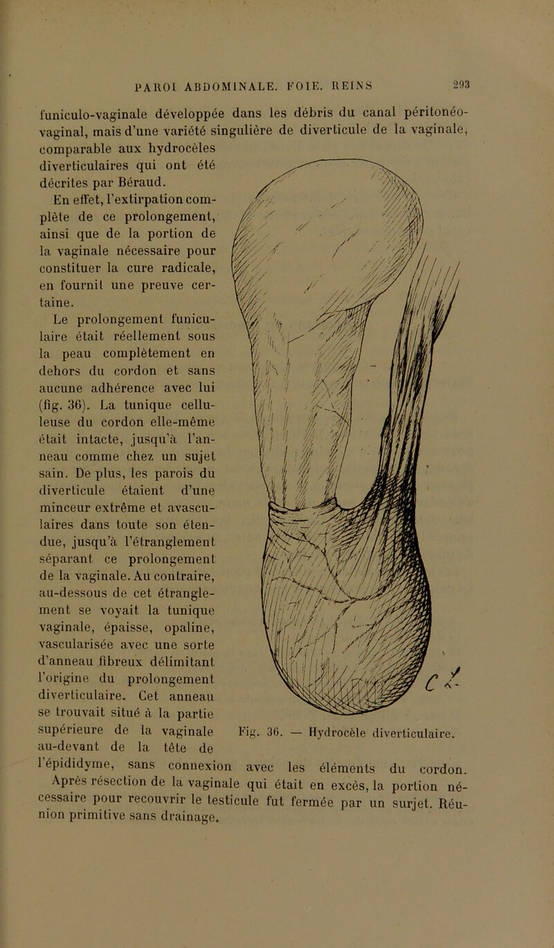 funiculo-vaginale développée dans les débris du canal péritonéo- vaginal, mais d’une variété singulière de diverticule de la vaginale, comparable aux hydrocèles diverticulaires qui ont été décrites par Béraud. En effet, l’extirpation com- plète de ce prolongement, ainsi que de la portion de la vaginale nécessaire pour constituer la cure radicale, en fournit une preuve cer- taine. Le prolongement funicu- laire était réellement sous la peau complètement en dehors du cordon et sans aucune adhérence avec lui (fig. 36). La tunique cellu- leuse du cordon elle-même était intacte, jusqu’à l’an- neau comme chez un sujet sain. De plus, les parois du diverticule étaient d’une minceur extrême et avascu- laires dans toute son éten- due, jusqu’à l’étranglement séparant ce prolongement de la vaginale. Au contraire, au-dessous de cet étrangle- ment se voyait la tunique vaginale, épaisse, opaline, vascularisée avec une sorte d’anneau fibreux délimitant l’origine du prolongement diverticulaire. Cet anneau se trouvait situé à la partie supérieure de la vaginale au-devant de la tête de 1 épididyme, sans connexion avec les éléments du cordon. Après résection de la vaginale qui était en excès, la portion né- cessaire pour recouvrir le testicule fut fermée par un surjet. Réu- nion primitive sans drainage. Fig. 36. — Hydrocèle diverticulaire.