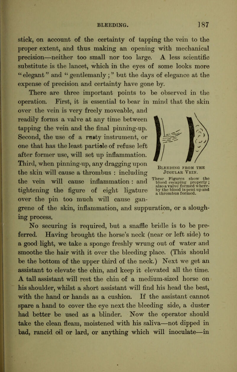 stick, on account of the certainty of tapping the vein to the proper extent, and thus making an opening with mechanical precision—neither too small nor too large. A less scientific substitute is the lancet, which in the eyes of some looks more “ elegant ” and “ gentlemanly; ” but the days of elegance at the expense of precision and certainty have gone by. There are three important points to be observed in the operation. First, it is essential to bear in mind that the skin over the vein is very freely moveable, and readily forms a valve at any time between tapping the vein and the final pinning-up. Second, the use of a ruaty instrument, or one that has the least partiole of refuse left after former use, will set up inflammation. Third, when pinning-up, any dragging upon the skin will cause a thrombus : including the vein will cause inflammation: and tightening the figure of eight ligature over the pin too much will cause gan- grene of the skin, inflammation, and suppuration, or a slough- ing process. No securing is required, but a snaffle bridle is to be pre- ferred. Having brought the horse’s neck (near or left side) to a good light, we take a sponge freshly wrung out of water and smoothe the hair with it over the bleeding place. (This should be the bottom of the upper third of the neck.) Next we get an assistant to elevate the chin, and keep it elevated all the time. A tall assistant will rest the chin of a medium-sized horse on his shoulder, whilst a short assistant will find his head the best, with the hand or hands as a cushion. If the assistant cannot spare a hand to cover the eye next the bleeding side, a duster had better be used as a blinder. Now the operator should take the clean fleam, moistened with his saliva—not dipped in bad, rancid oil or lard, or anything which will inoculate—in Bleeding from the Jugular Vein. These Figures show the blood escaping properly; also a valve formed where- by the blood is pent up and a thrombus formed.