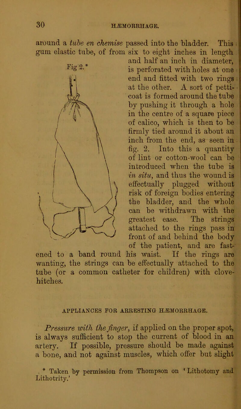 Fig 2. around a tube en chemise passed into the bladder. This , gum elastic tube, of from six to eight inches in length and half an inch in diameter, is perforated with holes at one end and fitted with two rings at the other. A sort of petti- coat is formed around the tube by pushing it through a hole in the centre of a square piece of calico, which is then to be firmly tied around it about an inch from the end, as seen in fig. 2. Into this a quantity of lint or cotton-wool can be introduced when the tube is in situ, and thus the wound is effectually plugged without risk of foreign bodies entering the bladder, and the whole can be withdrawn with the greatest ease. The strings attached to the rings pass in front of and behind the body of the patient, and are fast- ened to a band round his waist. If the rings are wanting, the strings can be effectually attached to the tube (or a common catheter for children) with clove- hitches. APPLIANCES FOR ARRESTING HAEMORRHAGE. Pressure with the finger, if applied on the proper spot, is always sufficient to stop the current of blood in an artery. If possible, pressure should be made against a bone, and not against muscles, which offer but slight * Taken by permission from Thompson on * Lithotomy and Lithotrity.’