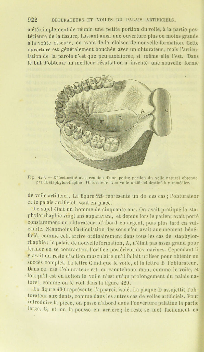 a 6t6 simplement de r6unir une petite portion du voile, a la partie pos- t^rieure de la fissure, laissant ainsi une ouverture plusou moins grande & la voute osseuse, en avantde la cloison de nouvelle formation. Cette ouverture est g6n6ralement bouchee avec un obturateur, mais l’articu- lation de la parole n’est que peu amelioree, si m&me elle Test. Dans le but d’obtenir un meilleur r6sultat on a invente une nouvelle forme Fig. 429. — Defectuosite avec reunion d’une petite, portion dn voile naturel obtenue par la staphylorrhaphie. Obturateur avec voile artificiel destine & y remedier. de voile artificiel. La figure428 repr6sente un de ces cas; l’obturaleur et le palais artificiel sont en place. Le sujel dtait un homme de cinquante ans. On avait pratique la sta- phylorrhaphie vingt ans auparavant, et depuis lors le patient avait porle constamment un obturateur, d’abord en argent, puis plus tard en vul- canite. Neanmoins l’articulation des sons n’en avail aucunement b£n6- fici<5, comme cela arrive ordinairement dans lous les cas de staphylor- rhaphie; le palais de nouvelle formation, A, n’6lait pas assez grand pour former en se contractant I’oritice postdrieur des narines. Cependanl ii y avait un resle d’action musculaire qu’il fallait ntiliser pour obtenir un succ^s complet. La lellre C indique le voile, et la lellre B l’obturateur. Dans ce cas i’oblurateur est en caoutchouc mou, comme le voile, et • lorsqu’il est en action le voile n’est qu’un prolongement du palais na- turel, comme on le voil dans la figure 429. La figure 430 reprfisente l’appareil isol<5. La plaque D assujettit Tob- lurateur aux dents, comme dans les aulres cas de voiles artificiels. Pour introduire la piece, on passe d’abord dans l’ouverlure palatine la partie large, C, et on la pousse en arriSre; le reste se met facilement en