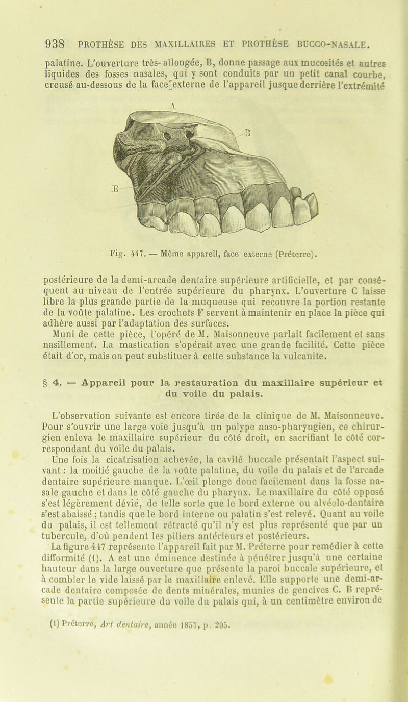 palatine. L’ouverture trds-allongde, B, donne passage aux mucosites et autres liquides des fosses nasales, qui y sont conduits par un petit canal courbe, creusd au-dessous de la face[externe de l’appareil jusque derridre l’extrdmitd Fig. 447. — Meme appareil, face externe (Prdterre). posterieure de la demi-arcade dentaire supdrieure artificielle, et par conse- quent au niveau de l’entrde superieure du pharynx. L’ouverture C laisse libre la plus grande partie de la muqueuse qui recouvre la portion restante de la voute palatine. Les crochets F servent amaintenir en place la piece qui adhere aussi par l’adaptation des surfaces. Muni de cetle piece, 1’opdre de M. Maisonneuve parlait facilement et sans nasillement. La mastication s’operait avec une grande facilite. Cette piece etait d or, maison peut substiluerct cette substance la vulcanite. §4. — Appareil pour la restauration du maxillaire supdrieur et du voile du palais. L’observation suivante est encore liree de la clinique de M. Maisonneuve. Pour s’ouvrir une large voie jusqu’a un polype naso-pharyngien, ce chirur- gien enleva le maxillaire sup6rieur du cote droit, en sacrifiant le cOle cor- respondant du voile du palais. Une fois la cicatrisation achevee, la cavite buccale presentail 1’aspect sui- vant: la moitie gauche de la voute palatine, du voile du palais et de l’arcade dentaire superieure manque. L’ccil plonge done facilement dans la fosse na- sale gauche et dans le cOld gauche du pharynx. Le maxillaire du cdte opposd s’est legerement ddvie, de telle sorte que le bord externe ou alveolo-dentaire s’est abaisse; landis que le bord interne ou palatin s’est relevd. Quant au voile du palais, il est tellemcnl r6tracld qu’il n’y esl plus reprdsente que par un tubercule, d’ou pendent les piliers antdrieurs et postdrieurs. La figure 417 reprdsente l’appareil fait par M. Preterre pour remddier ii cette difformitd (1). A est une eminence destinde a pdndtrer jusqu'A une certaine hauteur dans la large ouverlure que prdsente la paroi buccale superieure, et il combler le vide laissd par le maxillaire enlcvd. Elle supporle une demi-ar- cade dentaire composde de dents mind rales, munies de gencives C. B reprd- sente la partie supdrieure du voile du palais qui, ii un ccntimdtre environ de (I) Prdterre, Art dentaire, anndo 1857, p. 295.