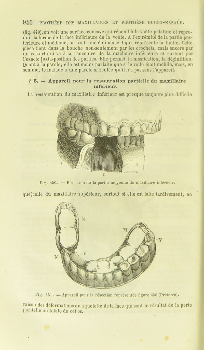 (fig. 449), on voit une surface concave qui rdpond a la vodte palatine el repro- duit la forme de la face inferieure de la votlte. A l’exlrdmitd de la partie pos- terieure et mddiane, on voit une eminence I qui reprdsente la luetle. Cette pidce tient dans la bouche non-seulement par les crochets, mais encore par un ressort qui va a la rencontre de la m&choire inferieure et surtout par Vexacte juxta-position des parties. Elle permet la mastication, la deglutition. Quant a la parole, elle est moins parfaite que si le voile etait mobile, mais, en somme, le malade a une parole articulee qu’il n’a pas sans 1’appareil. § 5. — Appareil pour la restauration partielle du maxillaire inferieur. La restauration du maxillaire inferieur est presque toujours plus difficile Fig. 450! — Resection de la partie moyenne du maxillaire inferieur. que^celle du maxillaire supdrieur, surtout si elle est faite tardivement, en Fig. 451. — Appareil pour la rdscction reprdsentde figure 450 (Prdterre). raison des ddformations du squelettc dela face quisont le rdsultat de la perto partielle ou totale de cet os.