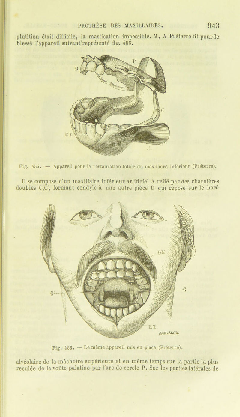 glutition etait difficile, la mastication impossible. M. A Prefer re fit pour le blessS l’appareil suivant'represente fig. 45S. Fig. 455. — Appareil pour la restauration totale du maxillaire inferieur (Pr6terre). 11 se compose d’un maxillaire inferieur arlificiel A reli6 par des charnteres doubles C,C', formant condyle a une autre pit;ce D qui repose sur le bord Fig. 456. — LemCime appareil mis en place (Prdterre). alv^olaire de la machoire supgrieuro et en memo temps sur la parlie la plus reculde de la vofite palatine par l’arc de cerclc P. Sur les parties lale'rales de