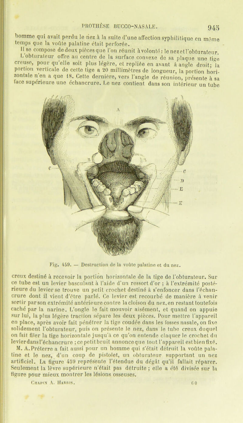 homme qui avait perdu le riez A la suite d’une affection syphilitique en miime temps que la voute palatine etait perforce. U se compose de deux pieces qne I’on reunit Avolonte: le nezetl’obturateur. Lobturateur offre au centre de la surface convexe de sa plaque une tige ere use, pour qu’elle soit plus legAre, et repliee en avant a angle droit; la portion verlicale de cette tige a ‘20 millimetres de longueur, la portion hori- zontale n'en a que 18. Cette derniAre, vers l’angle de reunion, presente a sa lace supeneure une echancrure. Le nez contient dans son interieur un tube Fig. 459. — Destruction de la voute palatine et dunez. creux destine a recevoir la portion horizontale de la tige de l’obturateur. Sur ce tube est un levier basculant a I’aide d’un ressortd’or ; a l’extremite poste- rieure du levier se trouve un petit crochet destind A s’enfoncer dans I’echan- crure dont il vient d’etre parle. Ce levier est recourbe de maniere venir sorlir parson extrdmite anterieure contre lacloisondu nez.en restant toutefois cache par la narine. L’ongle le fait mouvoir aisement, et quand on appuie sur lui, la plus legere traciion se’pare les deux pieces. Pour metlre I'appareil en place, apres avoir fait pen£trer la tige coudee dans les losses nasale, on fixe solidement l’obturateur, puis on presente le nez, dans le tube creux duquel on fait filer la tige horizontale jusqu’a ce qu’on entende claquer le crochet du levier dans l’echancrure ;ce petit bruit annoncequo tout I’appareil estbien fixe. M. A.Preterre a fait aussi pour un homme qui s’6lait detruit la voilte pala- tine et le nez, d’un coup de pistolet, un obturateur supportant un nez artificiel. La figure 459 repr6senle l’6tendue du degat qu’il fallait reparer. Seulement la lAvre sup6rieure n’6tait pas detruitc ; clle a 1H6 divisee sur la figure pour mieux montrer les 16sions osseuses. CHAPIX A. IfARRIS. CO