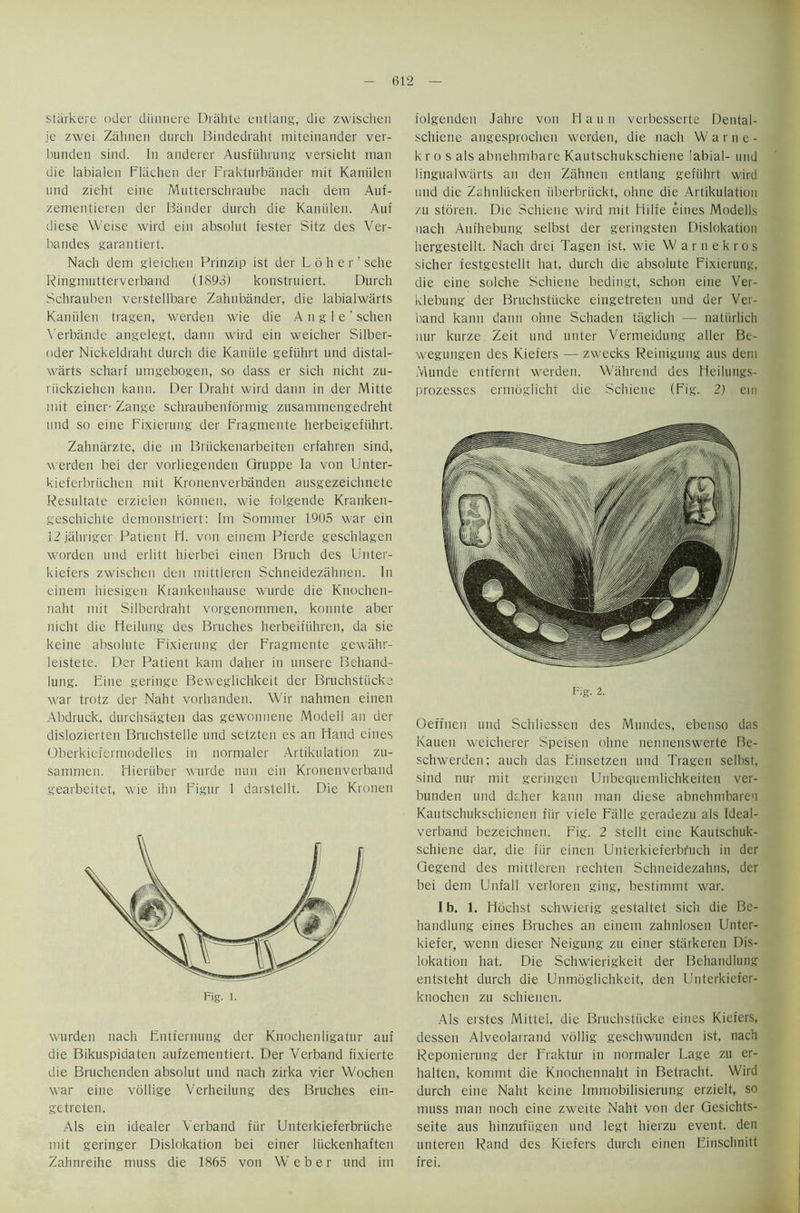 starkere Oder diinnere Drahte entlang, die zwischen je zwei Zahnen durch Bindedraht miteinander ver- bunden sind. In anderer Ausfiihrung versieht man die labialen Flachen der Frakturbiinder mit Kaniilen and zieht eine Mutterschraube nach dem Auf- zementieren der Bander durch die Kaniilen. Auf diese Weise wird ein absolut fester Sitz des Ver- bandes garantiert. Nach dem gleichen Prinzip ist der L 6 h e r ’ sche Ringmutterverband (1893) konstruiert. Durch Schrauben verstellbare Zahnbander, die labialwarts Kaniilen tragen, werden wie die Angle' schen Verbande angelegt, dann wird ein weicher Siiber- oder Nickeldraht durch die Kaniile gefiihrt und distal- warts scharf umgebogen, so dass er sich nicht zu- riickziehen kann. Der Draht wird dann in der Mitte mit einer- Zange schraubenformig zusanrmengedreht mid so eine Fixierung der Fragmente herbeigefiihrt. Zahniirzte, die in Briickenarbeiten erfahren sind, werden bei der vorliegenden Qruppe la von Unter- kieferbriichen mit Kronenverbanden ausgezeichnete Resultate erzielen konnen, wie folgende Kranken- geschichte demonstriert: 1m Sommer 1905 war ein 12 jahriger Patient ii. von einem Pterde geschlagen worden und erlitt hierbei einen Bruch des Unter- kieters zwischen den mittieren Schneidezalmen. In einem hiesigen Krankenhause wurde die Knochen- naht mit Silberdraht vorgenommen, konnte aber nicht die Heilung des Bruches herbeifiihren, da sie keine absolute Fixierung der Fragmente gewahr- leistete. Der Patient kam daher in unsere Behand- lung. Eine geringe Beweglichkeit der Bruchstiicke war trotz der Naht vorhanden. Wir nahmen einen Abdruck, durchsagten das gewonnene Modell an der dislozierten Bruchstelle und setzten es an Hand eines Oberkieiermodelles in normaler Artikulation zu- sammen. Hieriiber wurde nun ein Kronenverband gearbeitet, wie ihn Figur 1 darstellt. Die Kronen wurden nach Entfernung der Knochenligatur auf die Bikuspiaaten aufzementiert. Der Verband fixierte die Bruchenden absolut und nach zirka vier Wochen war eine vollige Verheilung des Bruches ein- getreten. Als ein idealer Verband fiir Unterkieferbriiche mit geringer Dislokation bei einer liickenhaften Zahnreihe muss die 1865 von Weber und im folgenden Jahre von Haun verbesserte Dental- schiene angesprochen werden, die nach Warne- k r o s als abnehmbare Kautschukschiene labial- und lingualwiirts an den Zahnen entlang gefiihrt wird und die Zahnliicken uberbriickt, ohne die Artikulation zu storen. Die Schiene wird mit Hilfe eines Modells nach Aufhebung selbst der geringsten Dislokation hergestellt. Nach drei Tagen ist, wie Warnekros sicher festgestellt hat, durch die absolute Fixierung, die eine solche Schiene bedingt, schon eine Ver- klebung der Bruchstiicke eingetreten und der Ver- band kann dann ohne Schaden taglich — natiirlich nur kurze Zeit und unter Vermeidung alter Be- wegungen des Kiefers — zwecks Reinigung aus dem Munde entfernt werden. Wahrend des Heilungs- prozesses ermoglicht die Schiene (Fig. 2) eiri Fig. 2. Oeffnen und Schliessen des Mundes, ebenso das Kauen weicherer Speisen ohne nennenswerte Be- schwerden; auch das Einsetzen und Tragen selbst, sind nur mit geringen Unbequemlichkeiten ver- bunden und daher kann man diese abnehmbareu Kautschukschienen fiir viele Fiille geradezu als Ideal- verband bezeichnen. Fig. 2 stellt eine Kautschuk- schiene dar, die fiir einen Unterkieferbruch in der Gegend des mittieren rechten Schneidezahns, der bei dem Unfall verloren ging, bestinimt war. I b. 1. Hochst schwierig gestaltet sich die Be- handlung eines Bruches an einem zahnlosen Unter- kiefer, wenn dieser Neigurig zu einer stiirkeren Dis- lokation hat. Die Schwierigkeit der Behandlung entsteht durch die Unmoglichkeit, den Unterkiefer- knochen zu schienen. Als erstcs Mittei, die Bruchstiicke eines Kiefers, dessen Alveolarrand vollig geschwunden ist, nach Reponierung der Fraktur in normaler Lage zu er- halten, komrnt die Knochennaht in Betracht. Wird durch eine Naht keine Immobilisierung erzielt, so muss man noch eine zweite Naht von der Gesichts- seite aus hinzufiigen und legt hierzu event, den unteren Rand des Kiefers durch einen Einschnitt frei.