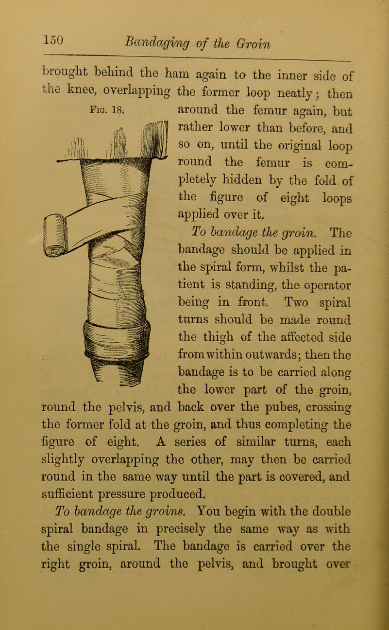 brought behind the ham again to the inner side of the knee, overlapping the former loop neatly • then Fig. 18. around the femur again, but rather lower than before, and so on, until the original loop round the femur is com- pletely hidden by the fold of the figure of eight loops applied over it. To bandage the groin. The bandage should be applied in the spiral form, whilst the pa- tient is standing, the operator being in front. Two spiral turns should be made round the thigh of the affected side from within outwards; then the bandage is to be carried along the lower part of the groin, round the pelvis, and back over the pubes, crossing the former fold at the groin, and thus completing the figure of eight. A series of similar turns, each slightly overlapping the other, may then be carried round in the same way until the part is covered, and sufficient pressure produced. To bandage the groins. You begin with the double spiral bandage in precisely the same way as with the single spiral. The bandage is carried over the right groin, around the pelvis, and brought over