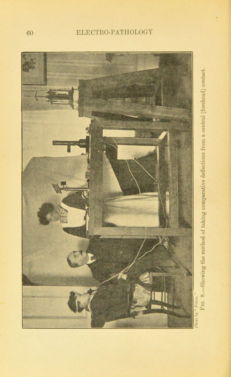 Pig. 9.—Showing tho method of taking comparative dofloctions from a central (forehead) contact.