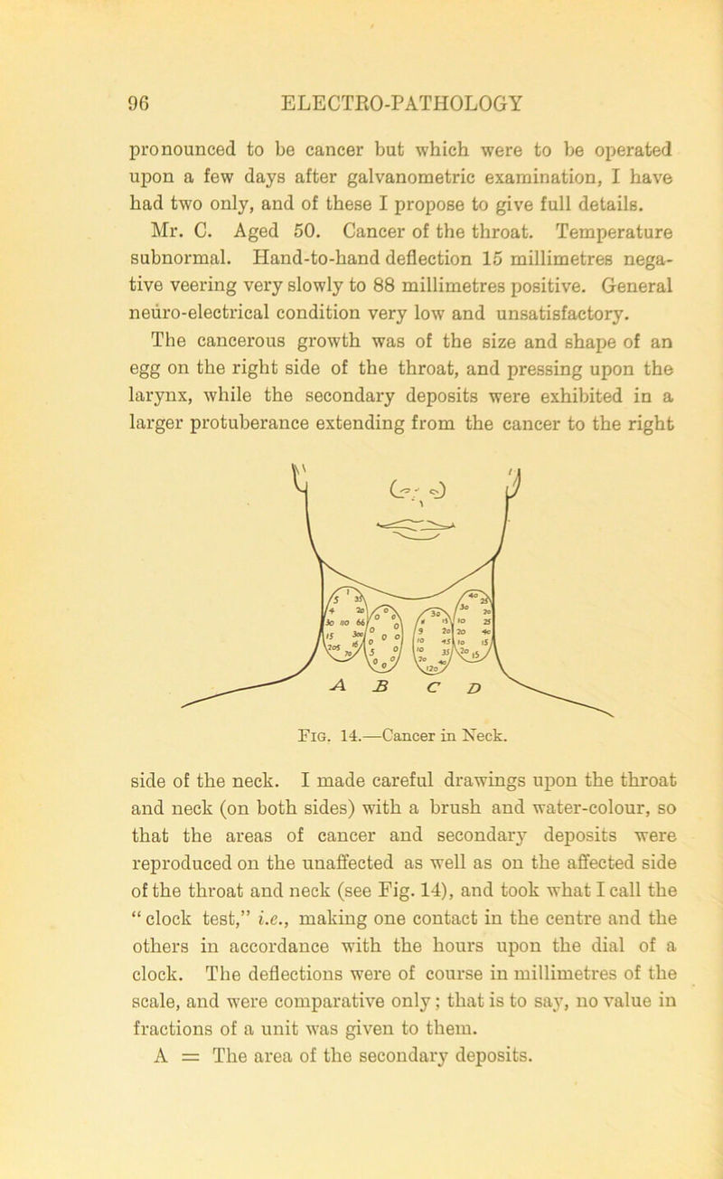 pronounced to be cancer but which were to be operated upon a few days after galvanometric examination, I have had two only, and of these I propose to give full details. Mr. C. Aged 50. Cancer of the throat. Temperature subnormal. Hand-to-hand deflection 15 millimetres nega- tive veering very slowly to 88 millimetres positive. General neuro-electrical condition very low and unsatisfactory. The cancerous growth was of the size and shape of an egg on the right side of the throat, and pressing upon the larynx, while the secondary deposits were exhibited in a larger protuberance extending from the cancer to the right side of the neck. I made careful drawings upon the throat and neck (on both sides) with a brush and water-colour, so that the areas of cancer and secondary deposits were reproduced on the unaffected as well as on the affected side of the throat and neck (see Fig. 14), and took what I call the “clock test,” i.e., making one contact in the centre and the others in accordance with the hours upon the dial of a clock. The deflections were of course in millimetres of the scale, and were comparative only; that is to say, no value in fractions of a unit was given to them. A = The area of the secondary deposits.