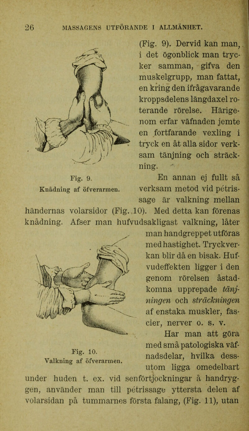 (Fig. 9). Dervid kan man,. i det ögonblick man tryc- ker samman, gifva den muskelgrupp, man fattat, en kring den ifrågavarande kroppsdelens längdaxel ro- terande rörelse. Härige- nom erfar väfnaden jemte en fortfarande vexling i tryck en åt alla sidor verk- sam tänjning och sträck- ning. Fig. 9. Knådning af öfverarmen. En annan ej fullt så verksam metod vid pétris- sage är valkning mellan händernas volarsidor (Fig. 10). Med detta kan förenas knådning. Afser man hufvudsakligast valkning, låter man handgreppet utföras med hastighet. Tryckver- kan blir då en bisak. Huf- vudeffekten ligger i den genom rörelsen åstad- komna upprepade tänj- ningen och sträckningen af enstaka muskler, fas- Fig. 10. Valkning af öfverarmen. Har man att göra med små patologiska väf- nadsdelar, hvilka dess- utom ligga omedelbart under huden t. ex. vid senförtjockningar å handryg- gen, använder man till pétrissage yttersta delen af volarsidan på tummarnes första falang, (Fig. 11), utan