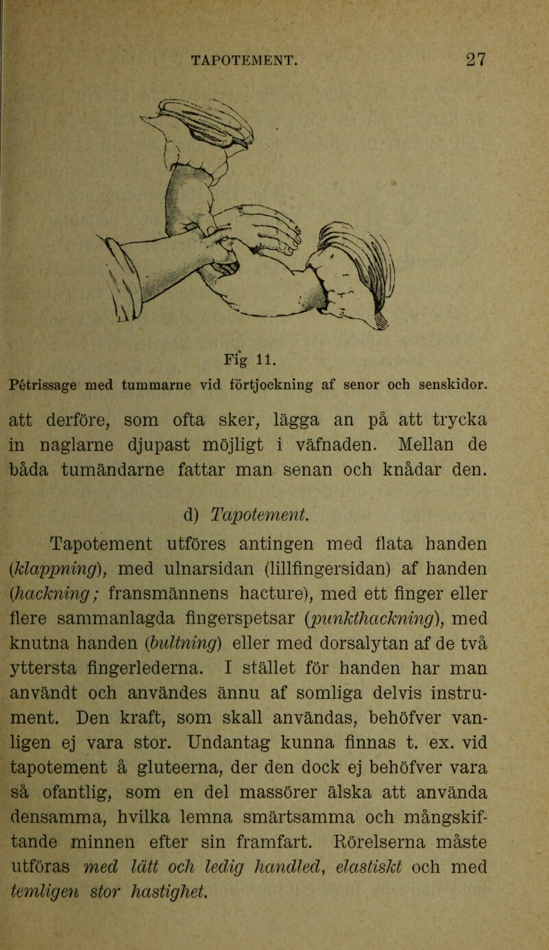 Pétrissage med tummarne vid förtjockning af senor och senskidor. att derföre, som ofta sker, lägga an på att trycka in naglarne djupast möjligt i väfnaden. Mellan de båda tumändarne fattar man senan och knådar den. d) Tapotement. Tapotement utföres antingen med flata handen {klappning), med ulnarsidan (lillfingersidan) af handen (hackning; fransmännens hacture), med ett finger eller flere sammanlagda fingerspetsar (punkthackning), med knutna handen (ihultning) eller med dorsalytan af de två yttersta fingerlederna. I stället för handen har man användt och användes ännu af somliga delvis instru- ment. Den kraft, som skall användas, behöfver van- ligen ej vara stor. Undantag kunna finnas t. ex. vid tapotement å gluteerna, der den dock ej behöfver vara så ofantlig, som en del massörer älska att använda densamma, hvilka lemna smärtsamma och mångskif- tande minnen efter sin framfart. Rörelserna måste utföras med lätt och ledig handled, elastiskt och med temligen stor hastighet.