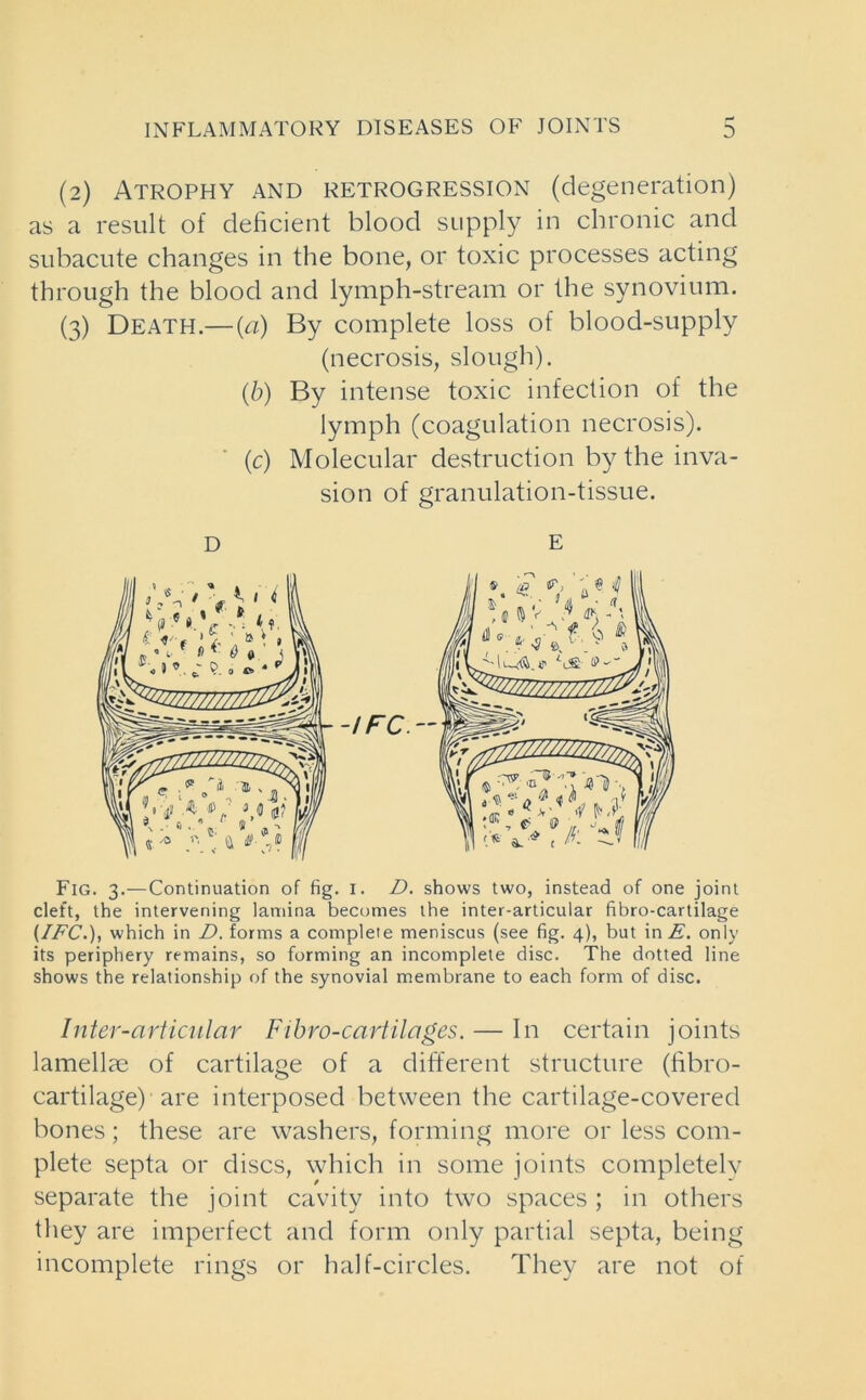 (2) Atrophy and retrogression (degeneration) as a result of deficient blood supply in chronic and subacute changes in the bone, or toxic processes acting through the blood and lymph-stream or the synovium. (3) Death.—{a) By complete loss of blood-supply (necrosis, slough). (b) By intense toxic infection of the lymph (coagulation necrosis). (c) Molecular destruction by the inva- sion of granulation-tissue. D E Fig. 3.—Continuation of fig. 1. D. shows two, instead of one joint cleft, the intervening lamina becomes the inter-articular fibro-cartilage {/EC.), which in D. forms a complete meniscus (see fig. 4), but in E. only its periphery remains, so forming an incomplete disc. The dotted line shows the relationship of the synovial membrane to each form of disc. Inter-articular Fibro-cartilages. — In certain joints lamellae of cartilage of a different structure (fibro- cartilage) are interposed between the cartilage-covered bones; these are washers, forming more or less com- plete septa or discs, which in some joints completely separate the joint cavity into two spaces ; in others they are imperfect and form only partial septa, being incomplete rings or half-circles. They are not of