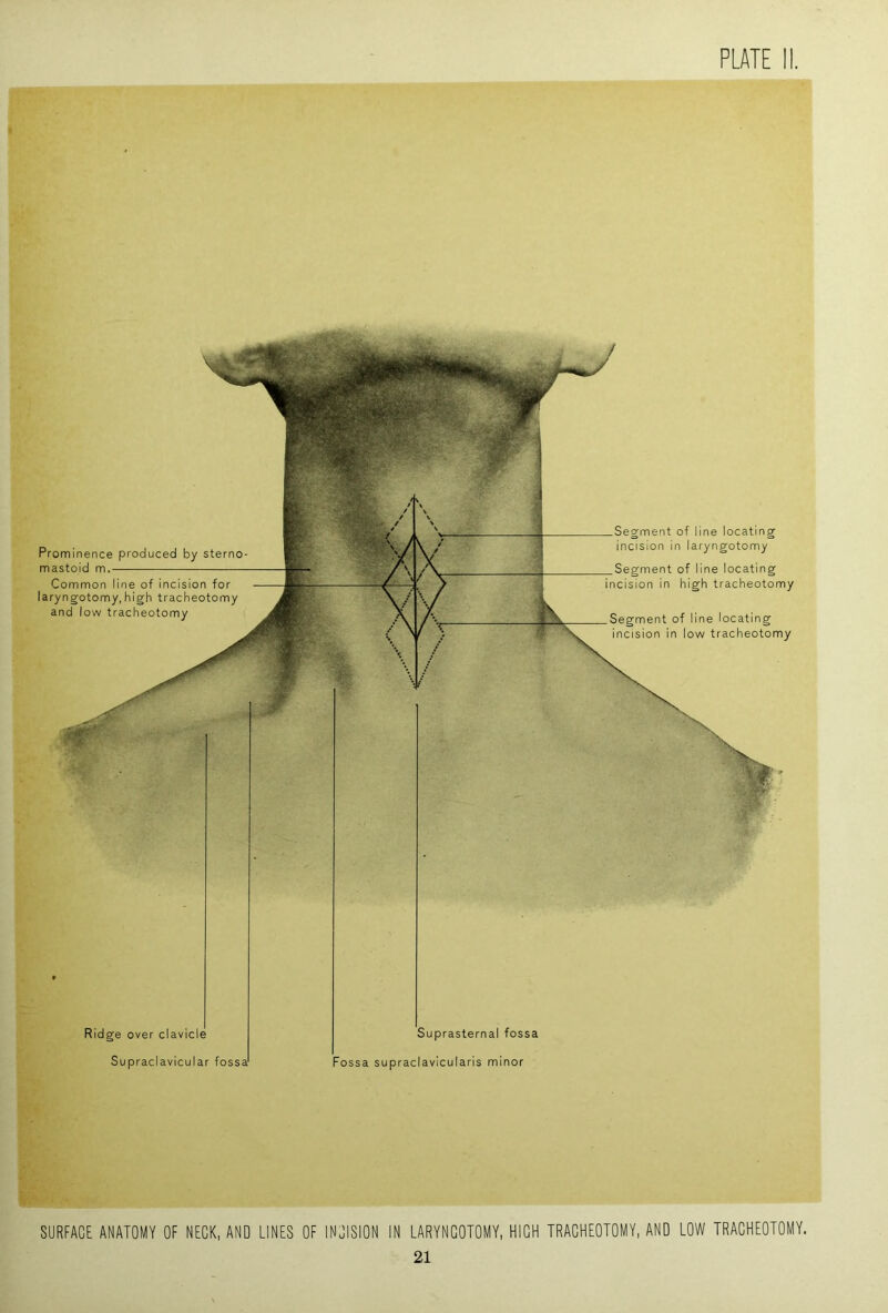 Prominence produced by sterno- mastoid m. Common line of incision for laryngotomy, high tracheotomy and low tracheotomy — Segment of line locating incision in laryngotomy — Segment of line locating incision in high tracheotomy .Segment of line locating incision in low tracheotomy Ridge over clavicle Supraclavicular fossa Suprasternal fossa Fossa supraclavicularis minor SURFACE ANATOMY OF NECK, AND LINES OF INCISION IN LARYNGOTOMY, HIGH TRACHEOTOMY, AND LOW TRACHEOTOMY. 21