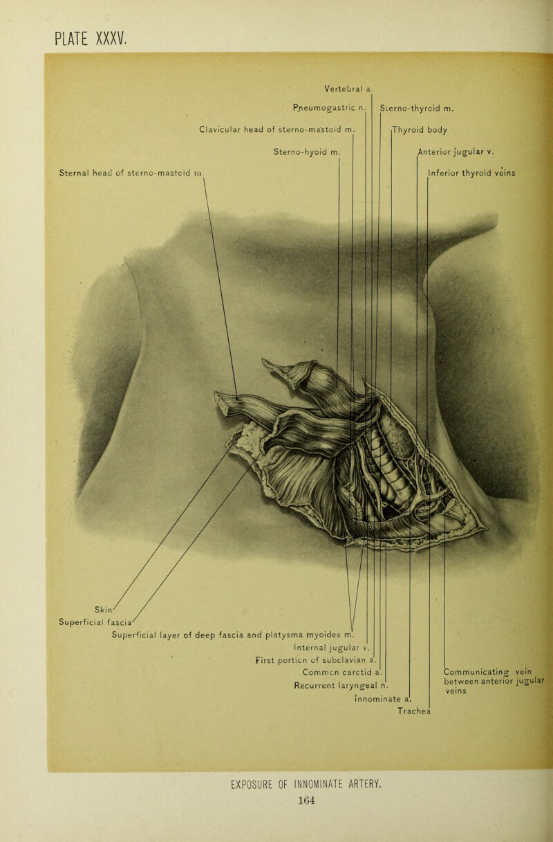 Vertebral a. Skin Superficial fascia Superficial layer of deep fascia and platysma rnyoides m. Internal jugular v. First portion of subclavian a'. Comrmcn carctid a', Recurrent laryngeal n'. Innominate a. Trachea Communicating vein between anterior jugular veins Pjieumogastric n Clavicular head of sterno-ma'stoid m, Sterno-hyoid m, Sternal head of sterno-mastcid m Sierno-thyrold m. Thyroid body Anterior jugular v. Inferior thyroid veins EXPOSURE OF INNOMINATE ARTERY.