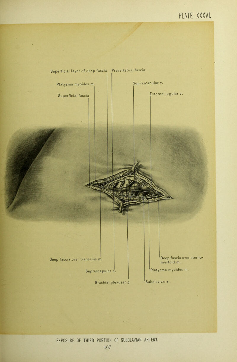 Superficial layer of deep fascia Prevertebral fascia Platysma myoides m Superficial fascia Suprascapular v. External jugular v. Deep fascia over trapezius m. Suprascapular n. Brachial plexus (n.) Deep fascia over sterno- mastoid m. Platysma myoides m. Subclavian a. EXPOSURE OF THIRD PORTION OF SUBCLAVIAN ARTERY.