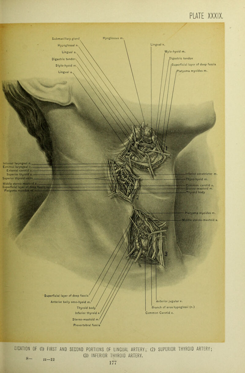 Superficial layer of deep fascia Anterior belly omo-hyoid m. Thyroid body Inferior thyroid a Sterno-mastoid m Prevertebral fascia Anterior jugular v. Branch of ansa hypoglossi (n.) Common Carotid a. Hyoglossus m. Inferior constrictor m. iThyro-hyoId m. Common carotid a. Sterno-mastoid m. roid body t. k Platysma myoldes m.. Middle sterno-mastoid a. Submaxillary gland Hypoglossal n. Lingual a. Digastric tendon Stylo-hyoid m Lingual a. Lingual v.. Mylo-hyoid m. gastric tendon uperficial layer of deep fascia a myoides m. Internal laryngeal n. Extarnal laryngeal n. External carotid a Superior thyroid a.— Superior thyroid ^ Middle sterno-mastoid Superficial layer of deep fascia. Platysma myoides ligation of (Ij FIRST AND SECOND PORTIONS OF LINGUAL ARTERY; , (3) INFERIOR THYROID ARTERY. (2) SUPERIOR THYROID ARTERY;