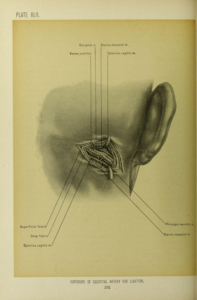 Superficial fasci Deep fascia Splenius capitis m. Princeps cervicis a. Sterno-mastoid m. Sterno-mastoid m. Splenius capitis m. Occipital a. Venae comites EXPOSURE OF OOOIPITAL ARTERY FOR LIGATION.