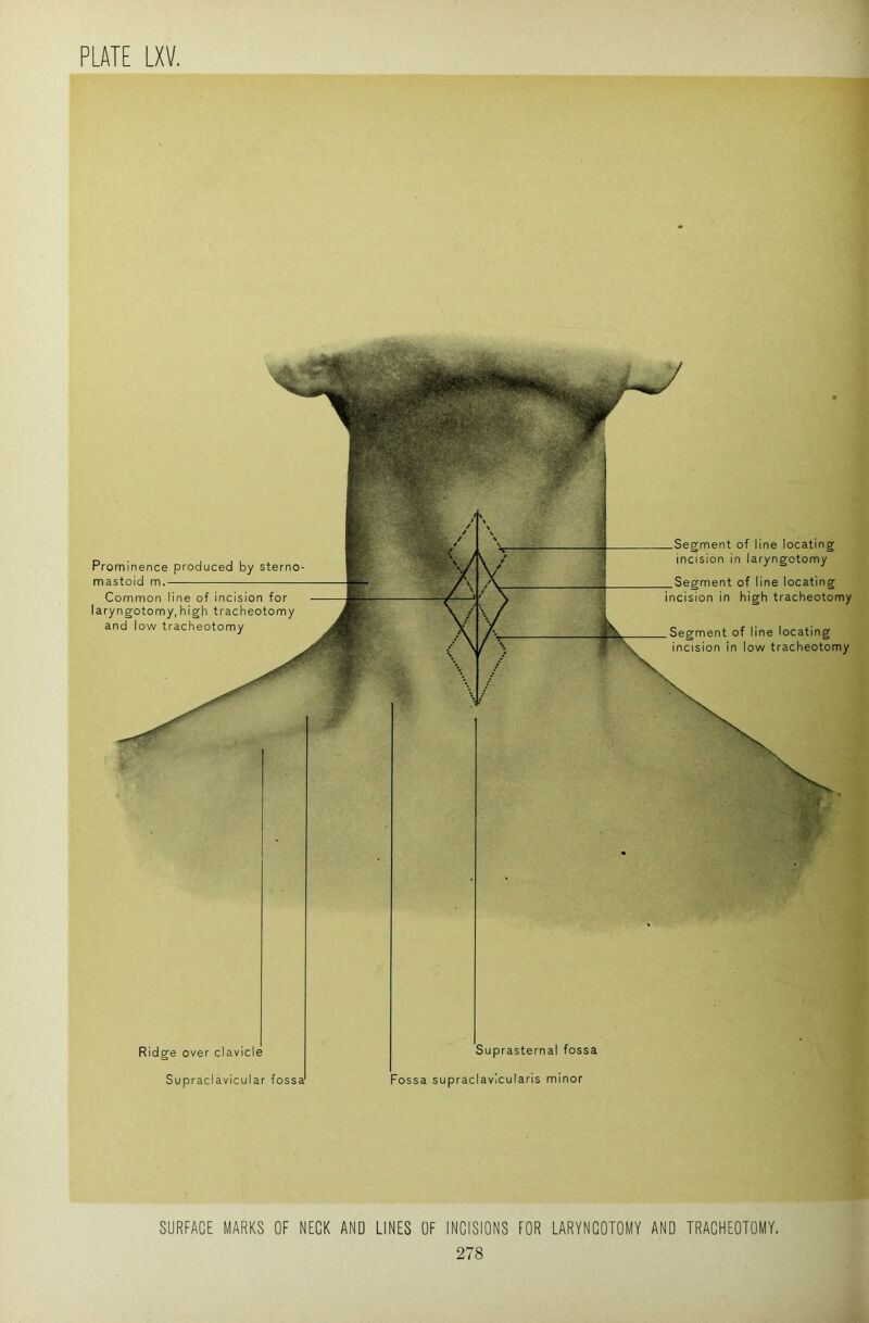 SURFACE MARKS OF NECK AND LINES OF INCISIONS FOR LARYNGOTOMY AND TRACHEOTOMY.