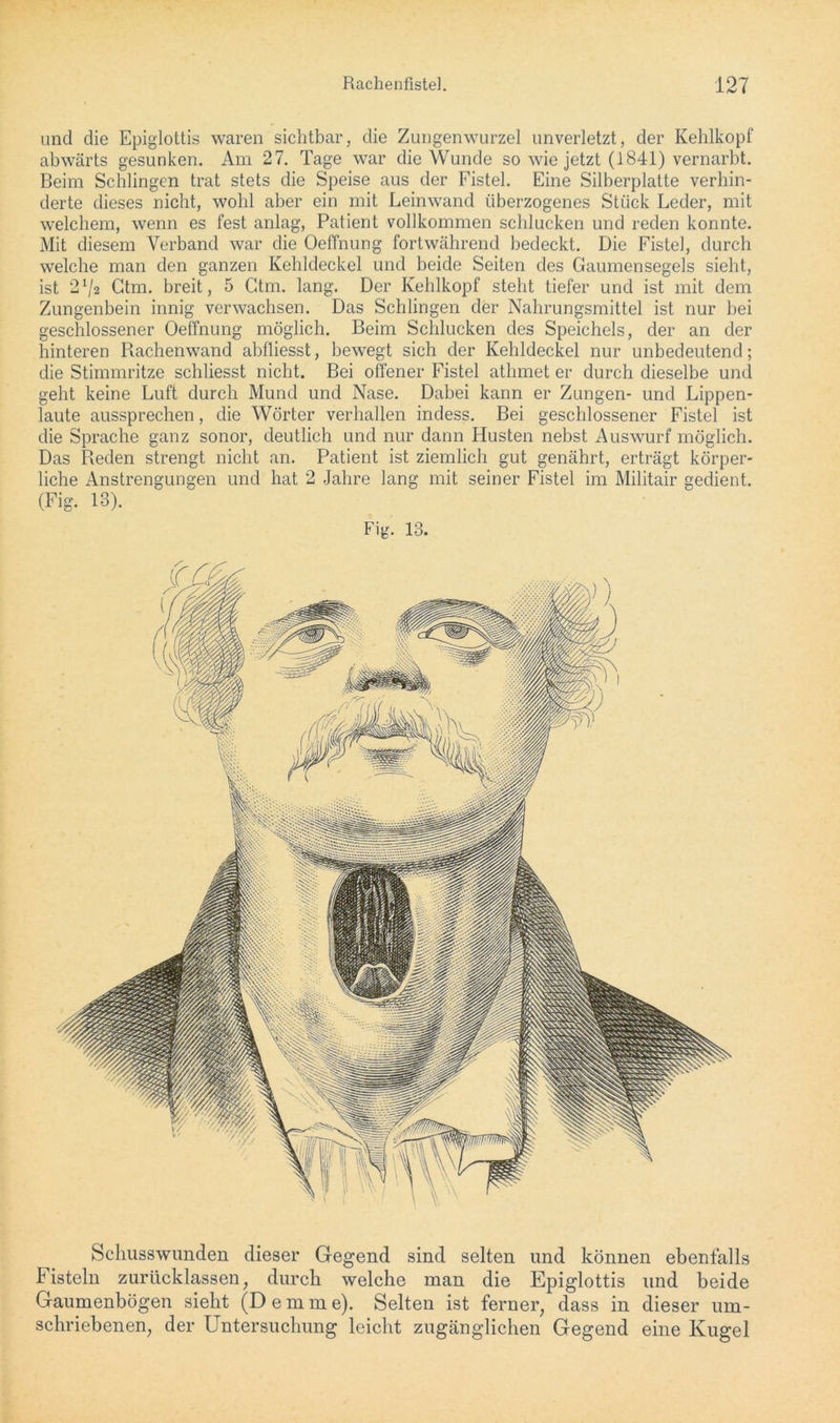 und die Epiglottis waren sichtbar, die Zungenwurzel unverletzt, der Kehlkopf abwärts gesunken. Am 27. Tage war die Wunde so wie jetzt (1841) vernarbt. Beim Schlingen trat stets die Speise aus der Fistel. Eine Silberplatte verhin- derte dieses nicht, wohl aber ein mit Leinwand überzogenes Stück Leder, mit welchem, wenn es fest anlag, Patient vollkommen schlucken und reden konnte. Mit diesem Verband war die Oeffnung fortwährend bedeckt. Die Fistel, durch welche man den ganzen Kehldeckel und beide Seiten des Gaumensegels sieht, ist 2V> Ctm. breit, 5 Ctm. lang. Der Kehlkopf steht tiefer und ist mit dem Zungenbein innig verwachsen. Das Schlingen der Nahrungsmittel ist nur bei geschlossener Oeffnung möglich. Beim Schlucken des Speichels, der an der hinteren Rachenwand abfliesst, bewegt sich der Kehldeckel nur unbedeutend; die Stimmritze schliesst nicht. Bei offener Fistel athmet er durch dieselbe und geht keine Luft durch Mund und Nase. Dabei kann er Zungen- und Lippen- laute aussprechen, die Wörter verhallen indess. Bei geschlossener Fistel ist die Sprache ganz sonor, deutlich und nur dann Husten nebst Auswurf möglich. Das Reden strengt nicht an. Patient ist ziemlich gut genährt, erträgt körper- liche Anstrengungen und hat 2 Jahre lang mit seiner Fistel im Militair gedient. (Fig. 13). Fig. 13. Schusswunden dieser Gegend sind selten und können ebenfalls Fisteln zurücklassen, durch welche man die Epiglottis und beide Gaumenbögen sieht (Demme). Selten ist ferner, dass in dieser um- schriebenen, der Untersuchung leicht zugänglichen Gegend eine Kugel
