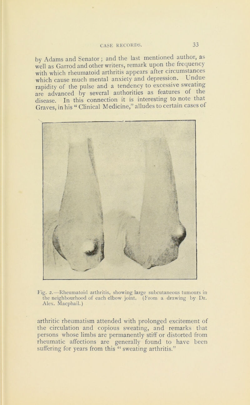 by Adams and Senator; and the last mentioned authoi, as well as Garrod and other writers, remark upon the frequency with which rheumatoid arthritis appears after circumstances which cause much mental anxiety and depression. Lndue rapidity of the pulse and a tendency to excessive sweating are advanced by several authorities as features of the disease. In this connection it is interesting to note that Graves, in his “ Clinical Medicine,” alludes to certain cases of Fig. 2.—Rheumatoid arthritis, showing large subcutaneous tumours in the neighbourhood of each elbow joint. (From a drawing by Dr. Alex. Macphail.) arthritic rheumatism attended with prolonged excitement of the circulation and copious sweating, and remarks that persons whose limbs are permanently stiff or distorted from rheumatic affections are generally found to have been suffering for years from this “ sweating arthritis.”