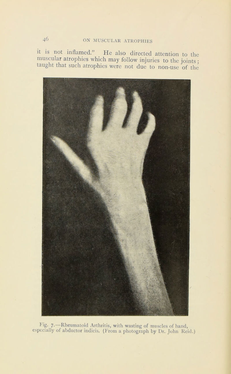 it is not inflamed.” He also directed attention to the muscular atrophies which may follow injuries to the joints; taught that such atrophies were not due to non-use of the Idg. 7.—Rheumatoid Arthritis, with wasting of muscles of hand, especially of abductor indicis. (From a photograph by Dr. John Reid.)