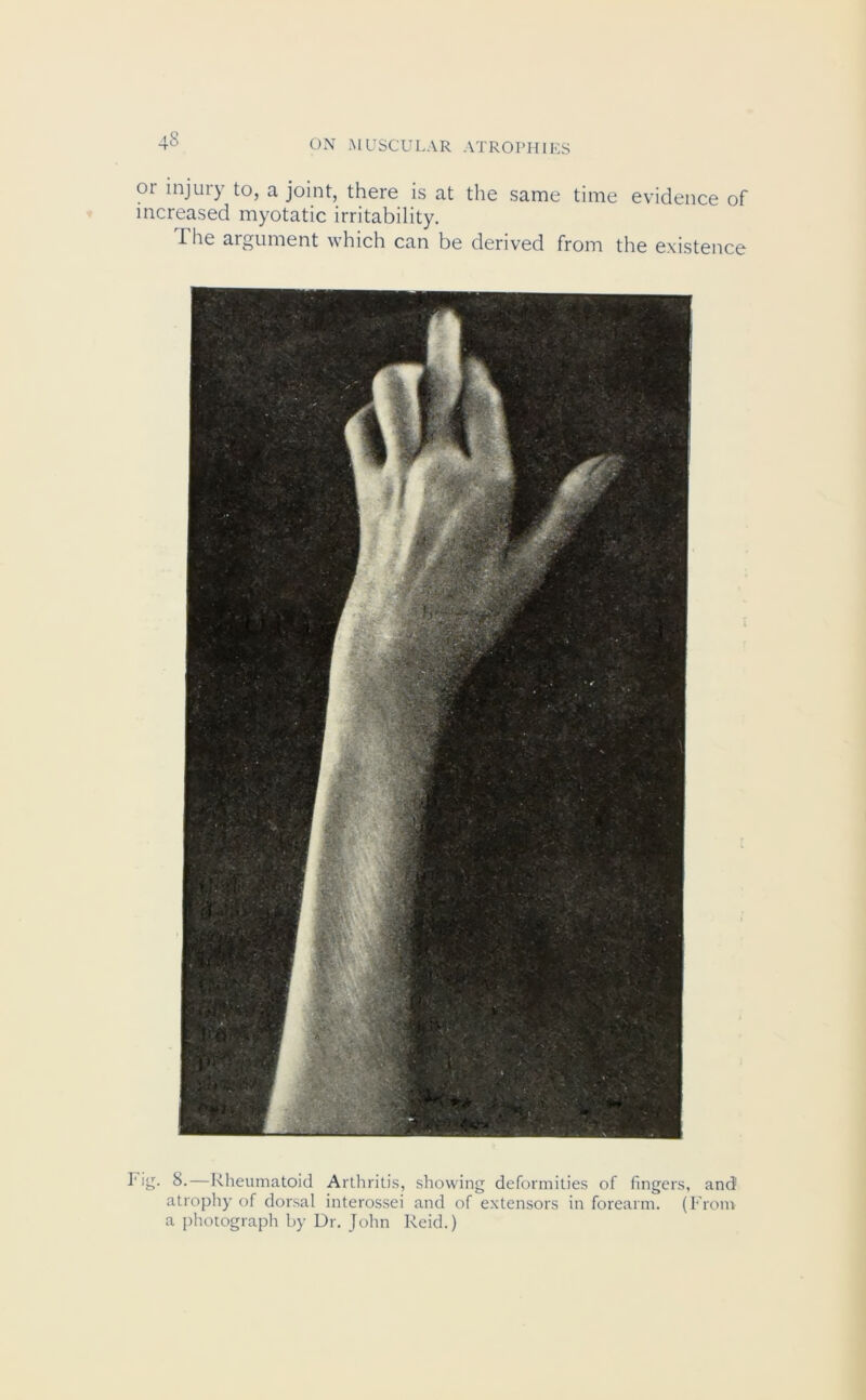 oi injury to, a joint, there is at the same time evidence of increased myotatic irritability. The argument which can be derived from the existence Fig. 8.—Rheumatoid Arthritis, showing deformities of fingers, and1 atrophy of dorsal interossei and of extensors in forearm. (From a photograph by Dr. John Reid.)