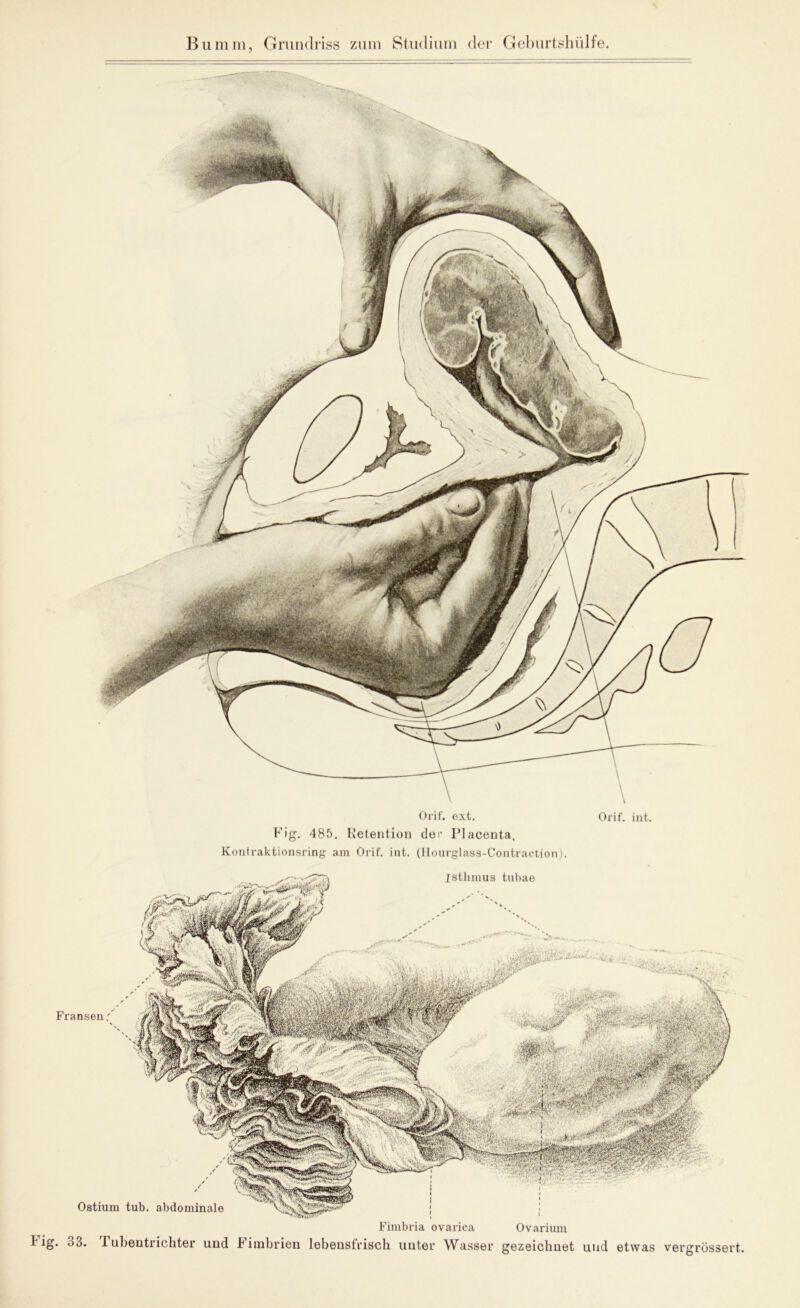 Orif. ext. Orif, int. Fig. 485. Retention def Placenta. Kontraktionsring am Orif. int. (Hourglass-Contraction). Fig. 33. Fimbria ovariea Tubentrichter und Fimbrien lebensfrisch unter Wasser Ovarium gezeichnet und etwas vergrössert.