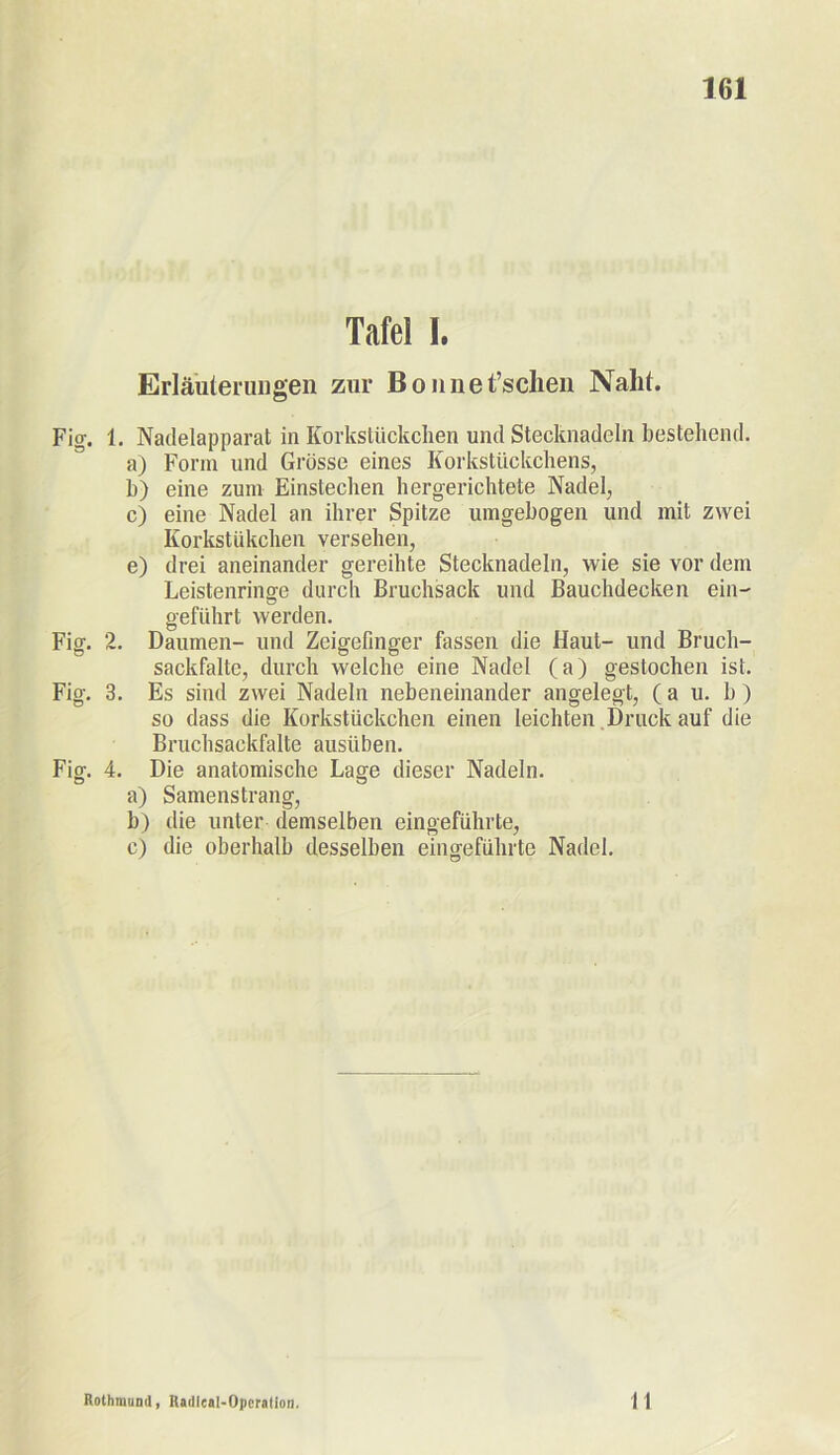 Tafel I. Erläuterungen zur Bonnet’sclien Naht. Fig. 1. Nadelapparat in Korkstückchen und Stecknadeln bestehend. a) Form und Grösse eines Korkstückchens, b) eine zum Einstechen hergerichtete Nadel, c) eine Nadel an ihrer Spitze umgebogen und mit zwei Korkstükchen versehen, e) drei aneinander gereihte Stecknadeln, wie sie vor dem Leistenringe durch Bruchsack und Bauchdecken ein- geführt werden. Fig. 2. Daumen- und Zeigefinger fassen die Haut- und Bruch- sackfalte, durch welche eine Nadel (a) gestochen ist. Fig. 3. Es sind zwei Nadeln nebeneinander angelegt, ( a u. b ) so dass die Korkstückchen einen leichten Druck auf die Bruchsackfalte ausüben. Fig. 4. Die anatomische Lage dieser Nadeln. a) Samenstrang, b) die unter demselben eingeführte, c) die oberhalb desselben eingeführte Nadel. Rothmund, Railleal-Operation 11