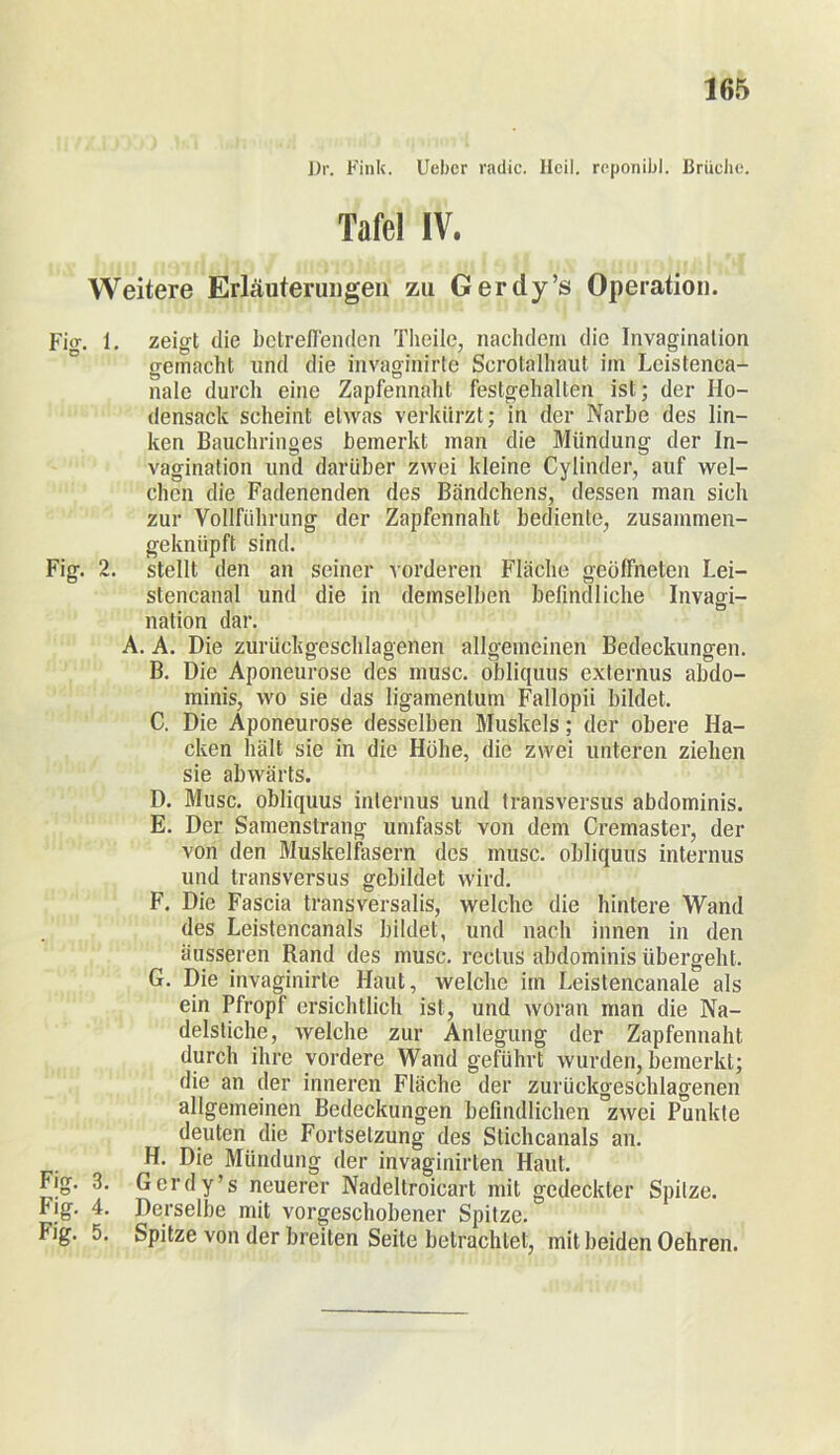 Dr. Fink. Ueber radle. Heil, reponibl. Brüche. Tafel IV. Weitere Erläuterungen zu Gerdy’s Operation. Fier. l. zeigt die betreffenden Theile, nachdem die Invagination gemacht lind die invaginirte Scrotalhaut im Leistenca- nale durch eine Zapfennaht festgehalten ist; der Ho- densack scheint etwas verkürzt; in der Narbe des lin- ken Bauchringes bemerkt man die Mündung der In- vagination und darüber zwei kleine Cylinder, auf wel- chen die Fadenenden des Bändchens, dessen man sich zur Vollführung der Zapfennaht bediente, zusammen- geknüpft sind. Fig. 2. stellt den an seiner vorderen Fläche geöffneten Lei- stencanal und die in demselben befindliche Invagi- nation dar. A. A. Die zurückgeschlagenen allgemeinen Bedeckungen. B. Die Aponeurose des musc. obliquus externus abdo- minis, wo sie das ligamentum Fallopii bildet. C. Die Aponeurose desselben Muskels; der obere Ha- cken hält sie in die Höhe, die zwei unteren ziehen sie abwärts. D. Musc. obliquus internus und transversus abdominis. E. Der Samenstrang umfasst von dem Cremaster, der von den Muskelfasern des musc. obliquus internus und transversus gebildet wird. F. Die Fascia transversalis, welche die hintere Wand des Leistencanals bildet, und nach innen in den äusseren Rand des musc. reelus abdominis übergeht. G. Die invaginirte Haut, welche irn Leistencanale als ein Pfropf ersichtlich ist, und woran man die Na- delstiche, welche zur Anlegung der Zapfennaht durch ihre vordere Wand geführt wurden, bemerkt; die an der inneren Fläche der zurückgeschlagenen allgemeinen Bedeckungen befindlichen zwei Punkte deuten die Fortsetzung des Stichcanals an. H. Die Mündung der invaginirten Haut. Fig. 3. Gerdy’s neuerer Nadeltroicart mit gedeckter Spitze. Fig. 4. Derselbe mit vorgeschobener Spitze. Fig. 5. Spitze von der breiten Seite betrachtet, mit beiden Oehren.