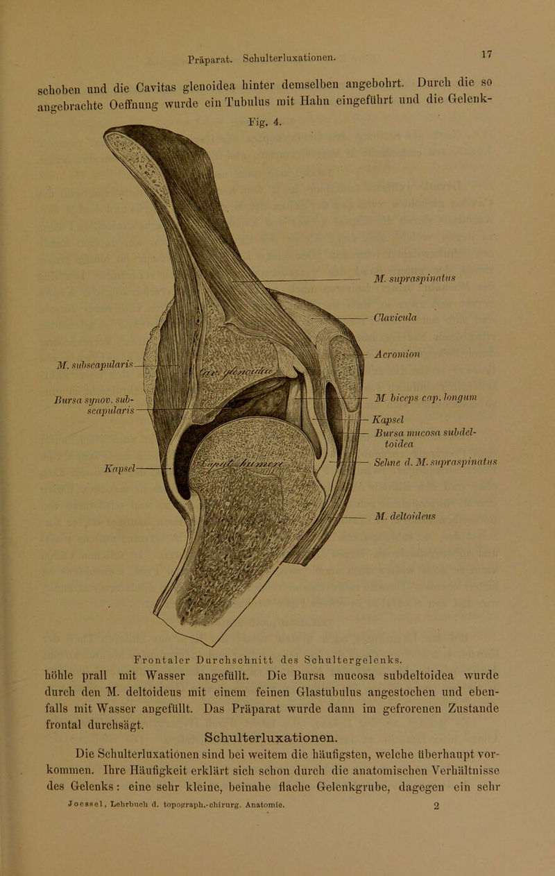 Präparat. Schulterluxationen. schoben und die Cavitas glenoidea hinter demselben angebohrt. Durch die so angebrachte Oeffnung wurde ein Tubulus mit Hahn eingeführt und die Gelenk- Frontaler Durchschnitt des Schultergelenks, höhle prall mit Wasser angefüllt. Die Bursa mucosa subdeltoidea wurde durch den TVI. deltoideus mit einem feinen Glastubulus angestochen und eben- falls mit Wasser angefüllt. Das Präparat wurde dann im gefrorenen Zustande frontal durchsägt. Schulterluxationen. Die Schulterluxationen sind bei weitem die häufigsten, welche überhaupt Vor- kommen. Ihre Häufigkeit erklärt sich schon durch die anatomischen Verhältnisse des Gelenks : eine sehr kleine, beinahe flache Gelenkgrube, dagegen ein sehr JocsRel, Lehrbuch <1. topograph.-chirurg. Anatomie. 2