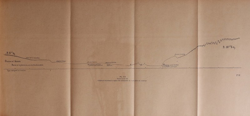 ^P.S-'bs ïfression art fémoral?/ Saisie it la jJrcsâionaacours de ch.!oroformis&Uon fiyie marquant Us minuits. ' Jfcntand, £uu naubd arrtt Fi,7. XII Ouseuvation 125 Graphique montrant la reprise des battements du cœur grâce au massage. ,*a/v wAa/V^ WV'VWVv~^ P= 10““l5 H5. Oî&aSSaQ,e direct, ducftttC iliniuf/laîîon gulmonaite.