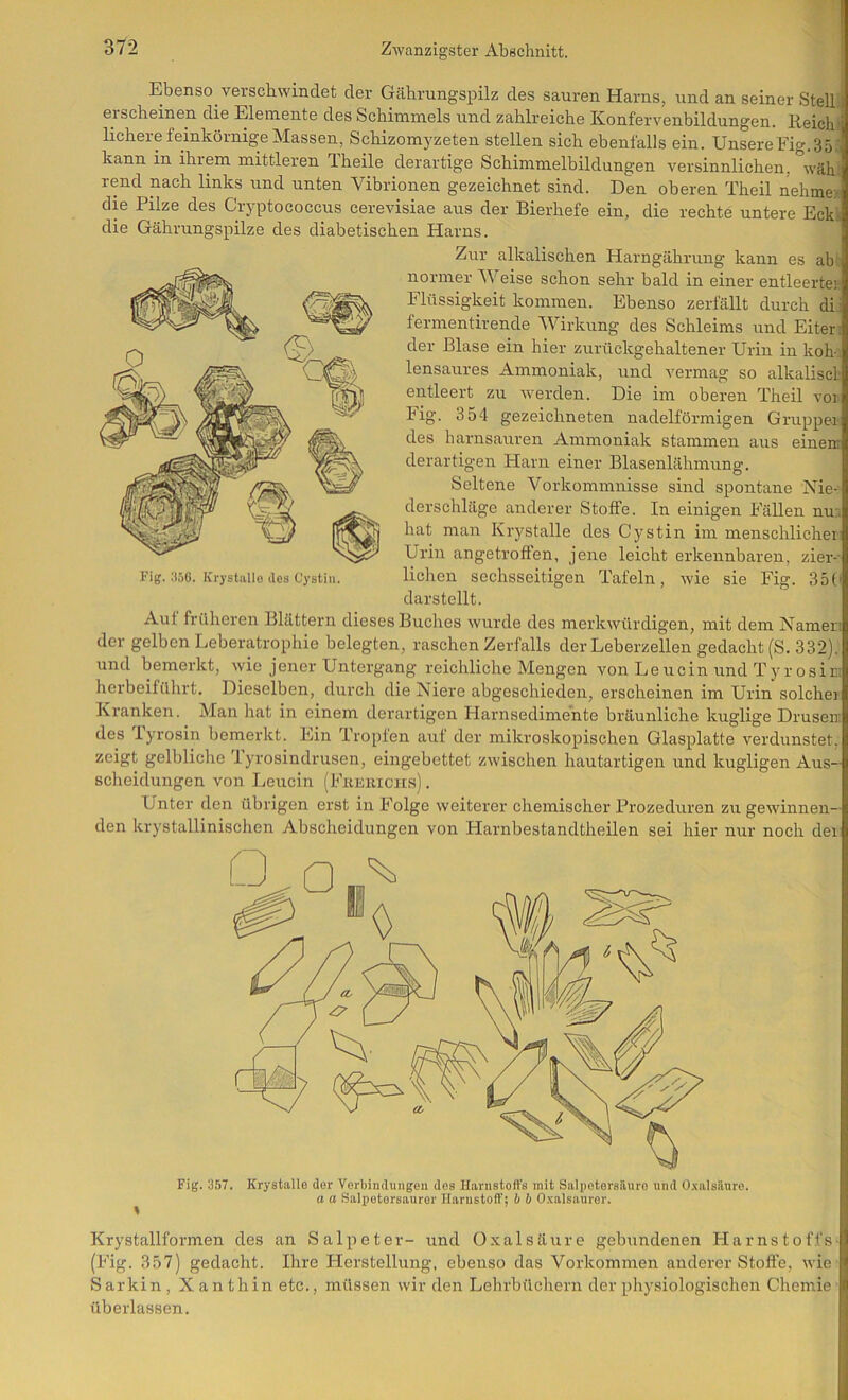 Ebenso verschwindet der Gährungspilz des sauren Harns, und an seiner Stell, erscheinen die Elemente des Schimmels und zahlreiche Konfervenbildungen. Reich' lichere feinkörnige Massen, Schizomj'zeten stellen sich ebenfalls ein. UnsereEig.3ö: kann in ihrem mittleren Theile derartige Schimmelbildungen versinnlichen, wäh’ rend nach links und unten Vibrionen gezeichnet sind. Den oberen Theil nehmex die Pilze des Cryptococcus cerevisiae aus der Bierhefe ein, die rechte untere EcW die Gährungspilze des diabetischen Harns. Zur alkalischen Harngährung kann es abl normer Weise schon sehr bald in einer entleerte): Flüssigkeit kommen. Ebenso zerfällt durch dii fermentirende Wirkung des Schleims und Eiter; der Blase ein hier zurückgehaltener Urin in koho lensaures Ammoniak, und vermag so alkaliscl entleert zu werden. Die im oberen Theil voi Fig. 354 gezeichneten nadelförmigen Gruppei- des harnsauren Ammoniak stammen aus einen derartigen Harn einer Blasenlähmung. Seltene Vorkommnisse sind spontane Nie-- derschläge anderer Stoffe. In einigen Fällen nu;i hat man Krystalle des Cystin im menschlichei Urin angetroffen, jene leicht erkennbaren, zier-' liehen sechsseitigen Tafeln, wie sie Fig. 35(' darstellt. Aul früheren Blättern dieses Buches wurde des merkwürdigen, mit dem Namen der gelben Leberatrophie belegten, raschen Zerfalls der Leberzellen gedacht (S. 332). und bemerkt, wie jener Untergang reichliche Mengen von Leucin und Tyrosin herbeiführt. Dieselben, durch die Niere abgeschieden, erscheinen im Urin solche) Kranken. Man liat in einem derartigen Harnsedimente bräunliche kuglige Drusen des Tyrosin bemerkt. Ein Tropfen auf der mikroskopischen Glasplatte verdunstet, zeigt gelbliclie lyrosindrusen, eingebettet zwischen hautartigen irnd kugligen Aus- scheidungen von Leucin (Fiuiiiiciis). Unter den übrigen erst in Folge weiterer chemischer Prozeduren zu gewinnen- den krystallinischen Abscheidungen von Harnbestandtheilen sei hier nur noch dei Fig. 357. Krystalle der Verljiaduugen des Harnstoffs mit Salpetersäure und O-valsäure. a a Salpetorsauror Harnstoff; b b O.^alsauror. Krystallformen des an Salpeter- und O.valsäure gebundenen Harnstoffs (Fig. 357) gedacht. Ihre Herstellung, ebenso das Vorkommen anderer Stoft'e, wie Sarkin, Xanthin etc., müssen wir den Lehrbüchern der physiologischen Chemie überlassen. Fig. 356. Krystallo des Cystin.