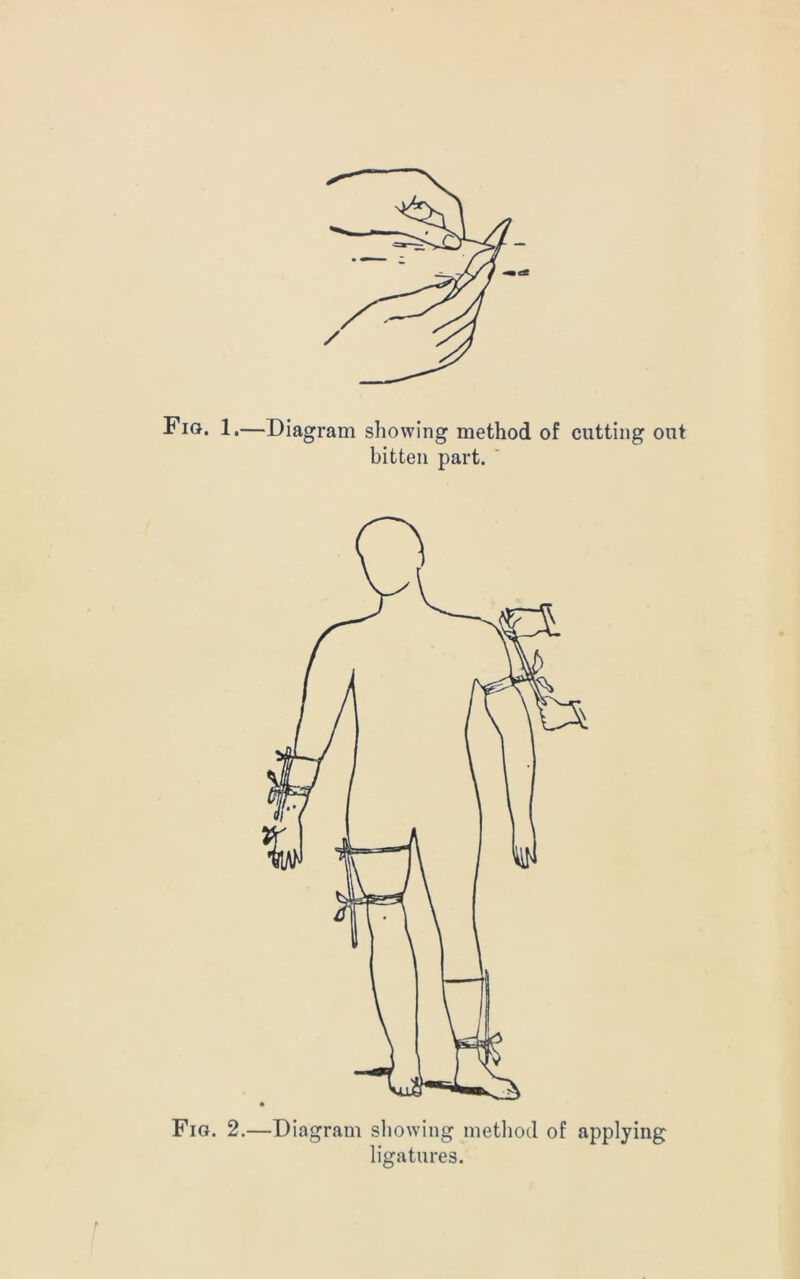 Fig. 1.—Diagram showing method of cutting out bitten part. Fig. 2.—Diagram showing method of applying ligatures.