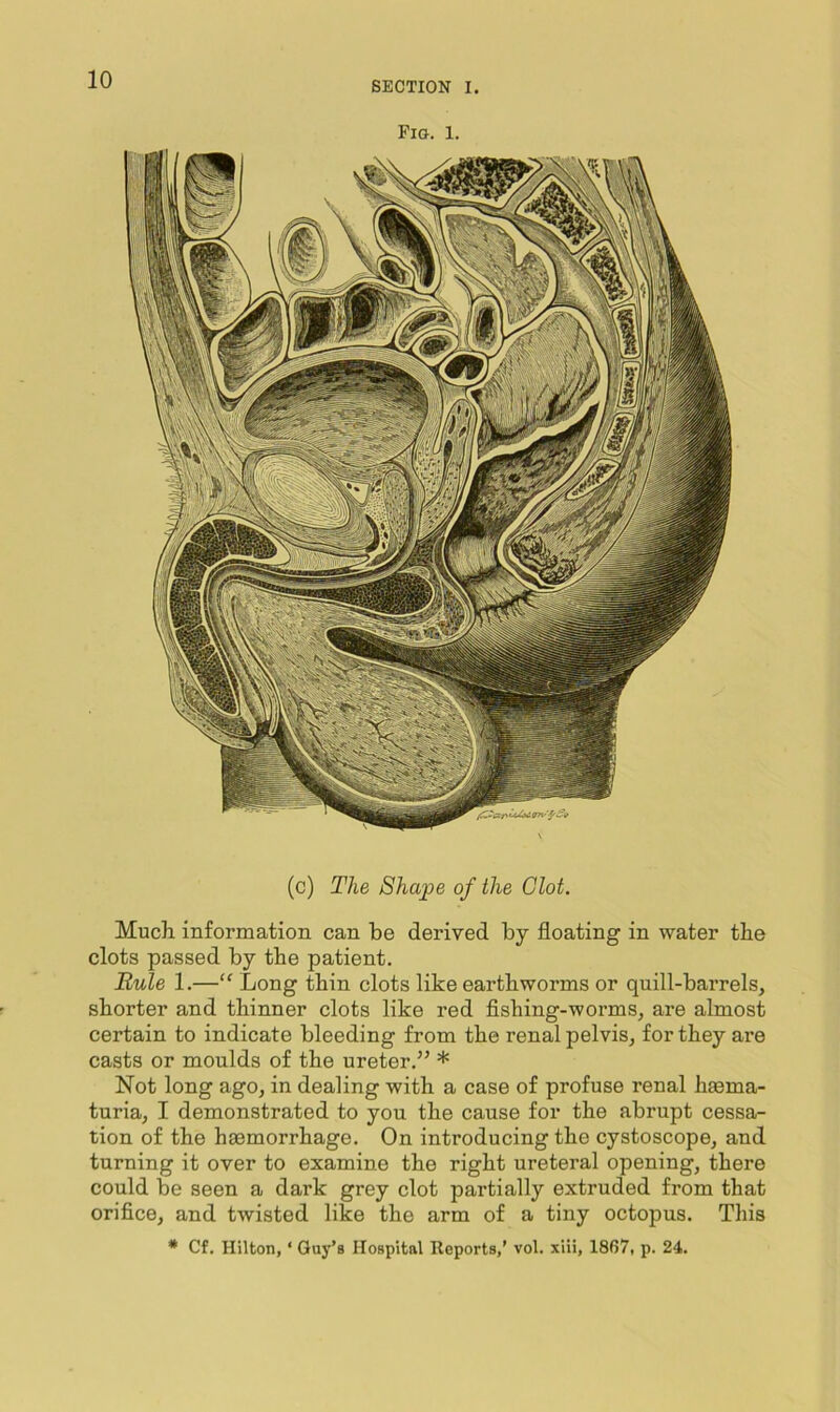SECTION I. Fig. 1. (c) The Shape of the Clot. Much, information can be derived by floating in water the clots passed by the patient. Rule 1.—“ Long thin clots like earthworms or quill-barrels, shorter and thinner clots like red flshing-worms, are almost certain to indicate bleeding from the renal pelvis, for they are casts or moulds of the ureter.” * Not long ago, in dealing with a case of profuse renal hasma- turia, I demonstrated to you the cause for the abrupt cessa- tion of the haemorrhage. On introducing the cystoscope, and turning it over to examine the right ureteral opening, there could be seen a dark grey clot partially extruded from that orifice, and twisted like the arm of a tiny octopus. This * Cf. Hilton, ‘ Guy’s Hospital Keports,’ vol. xiii, 1867, p. 24.